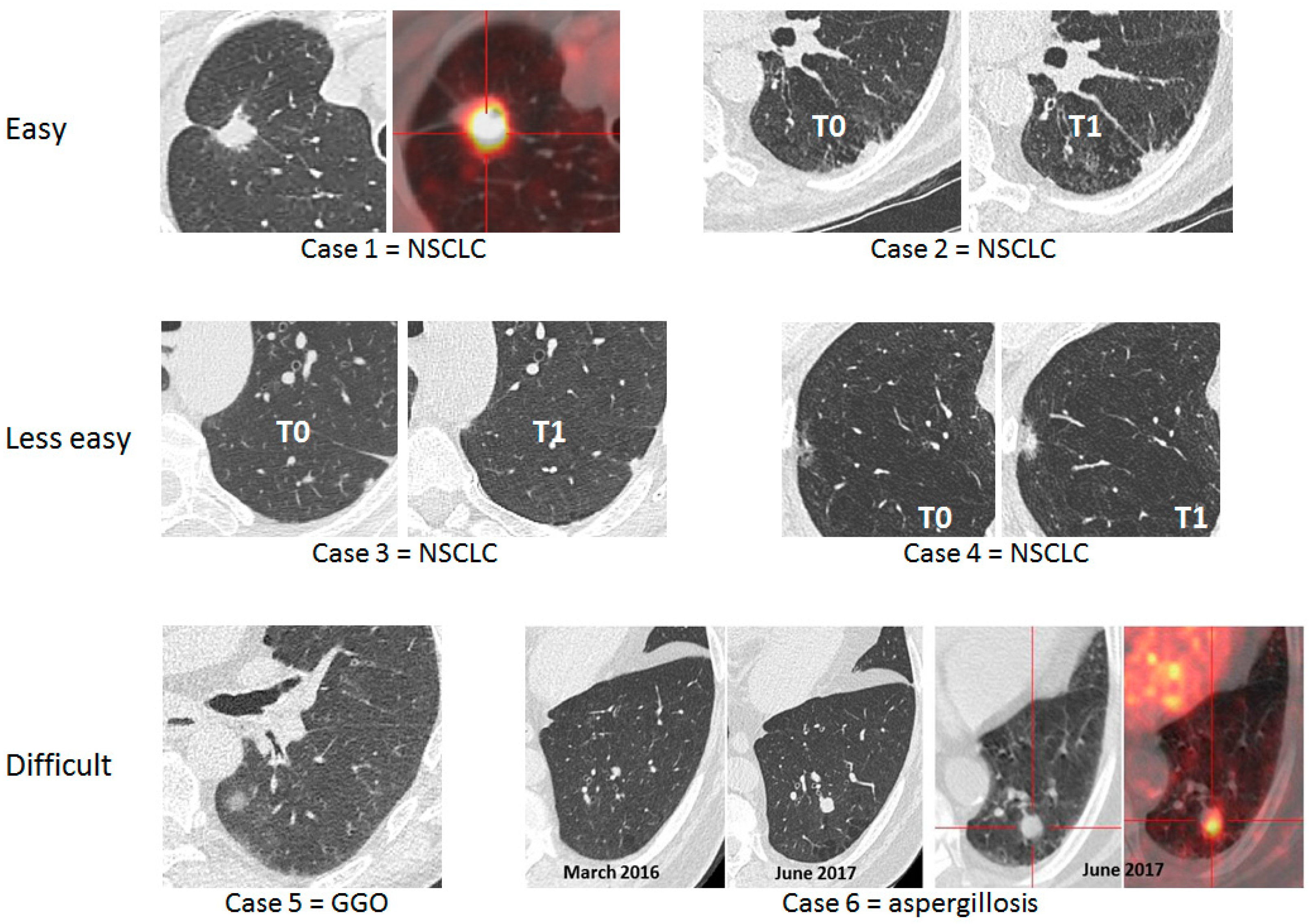 Cancers Free FullText Lung Cancer Screening, towards a
