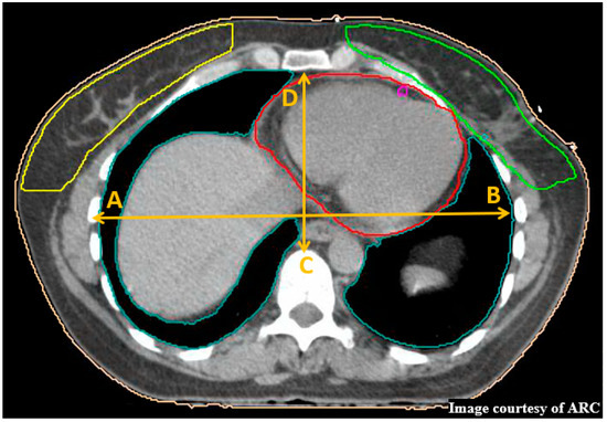 A Retrospective Dosimetric Study of Radiotherapy Patients with