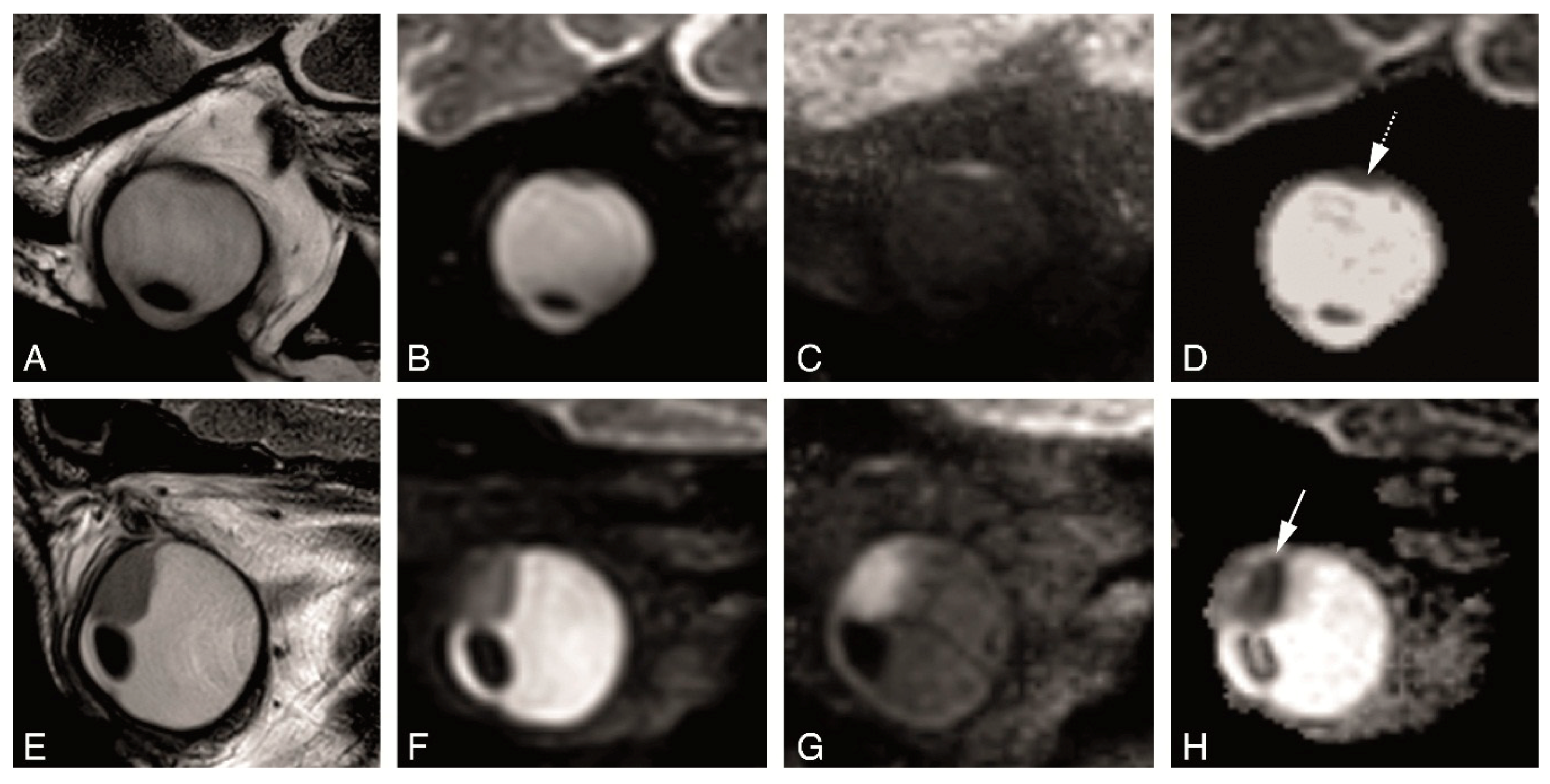 Cancers Free Full Text Mri Of Uveal Melanoma Html