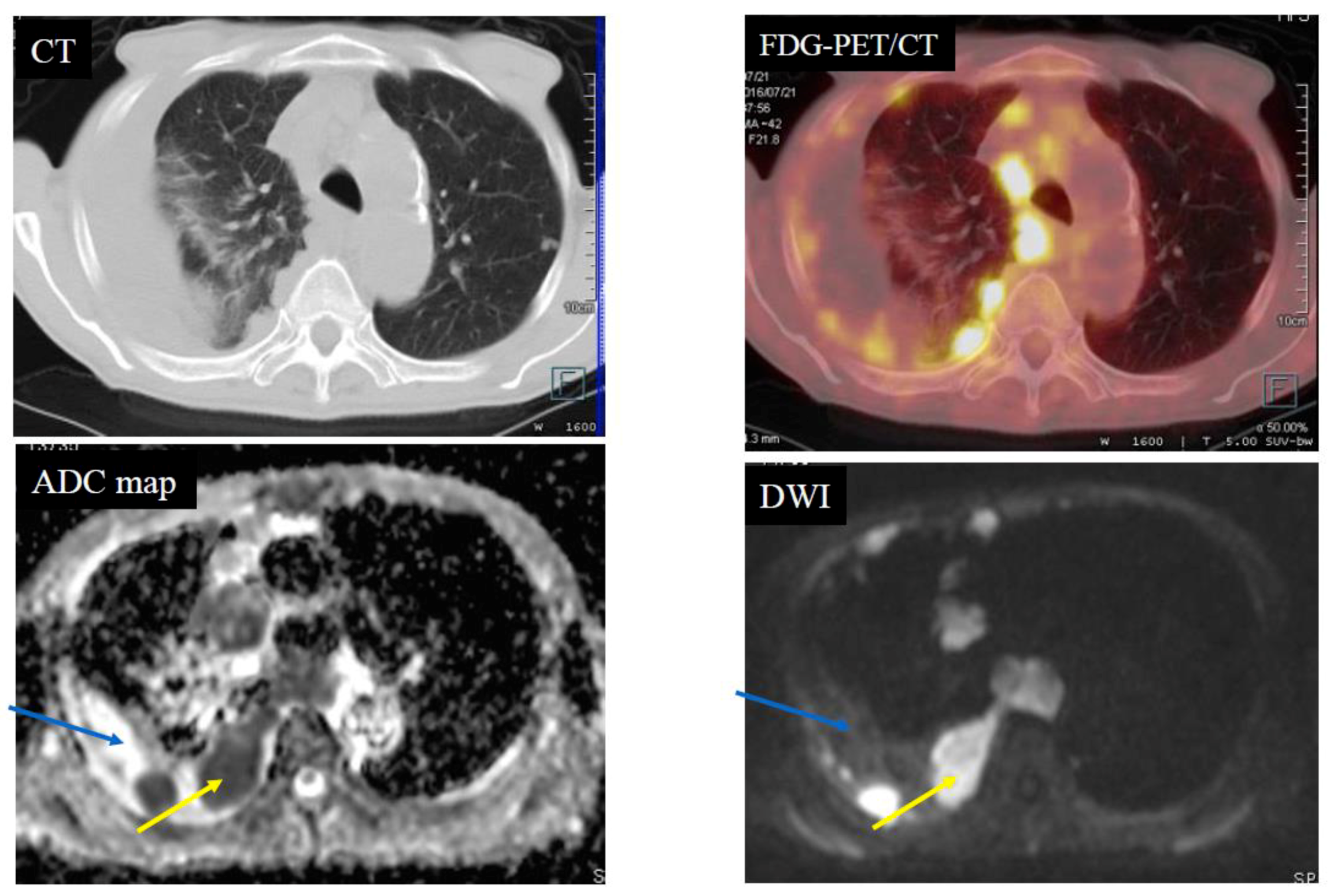 mesothelioma research funding