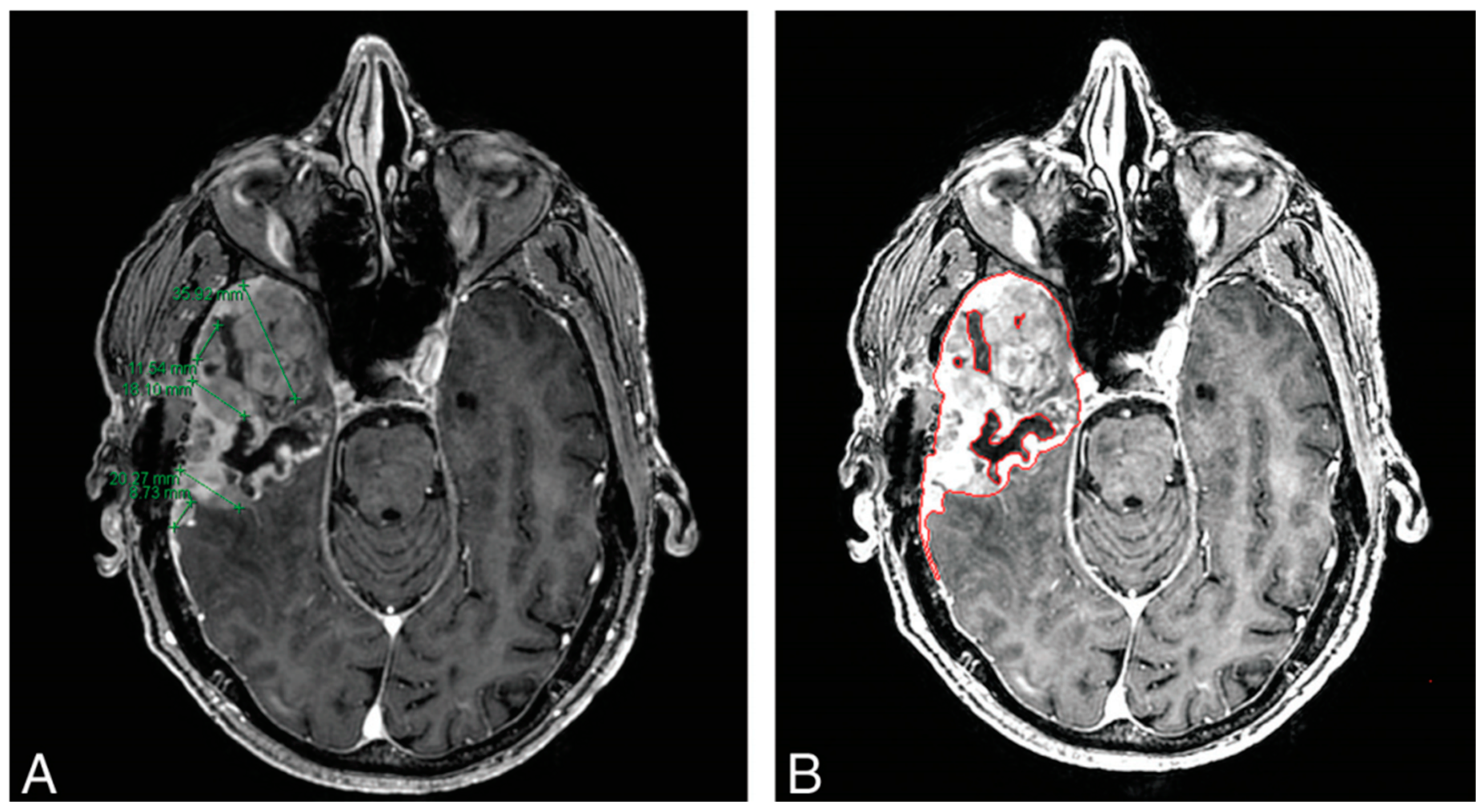 Cancers Free Full Text Optimizing Neuro Oncology Imaging A Review Of Deep Learning Approaches For Glioma Imaging Html