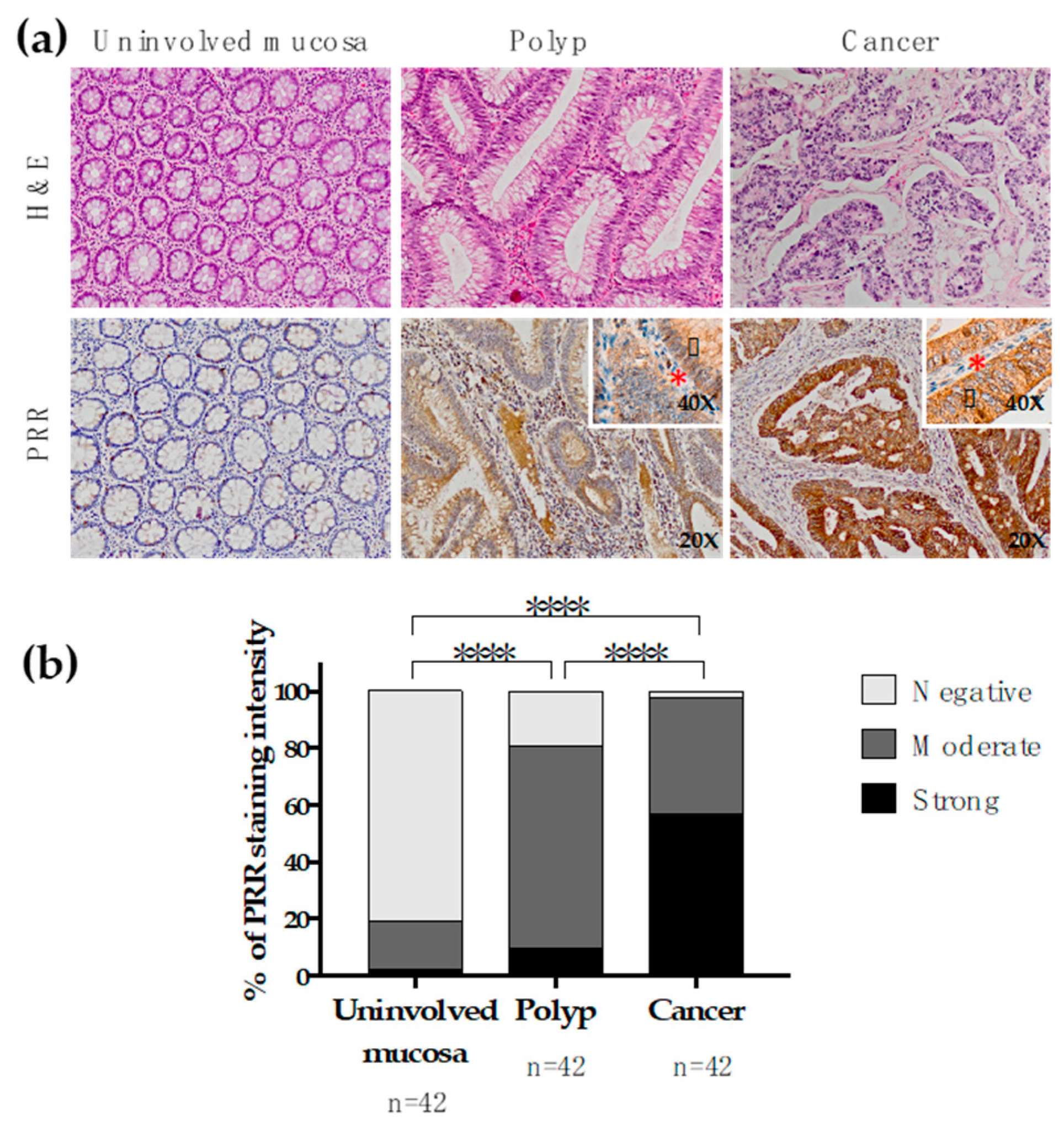 Cancers Free Full Text Pro Renin Receptor Expression Increases Throughout The Colorectal Adenoma Adenocarcinoma Sequence And It Is Associated With Worse Colorectal Cancer Prognosis Html
