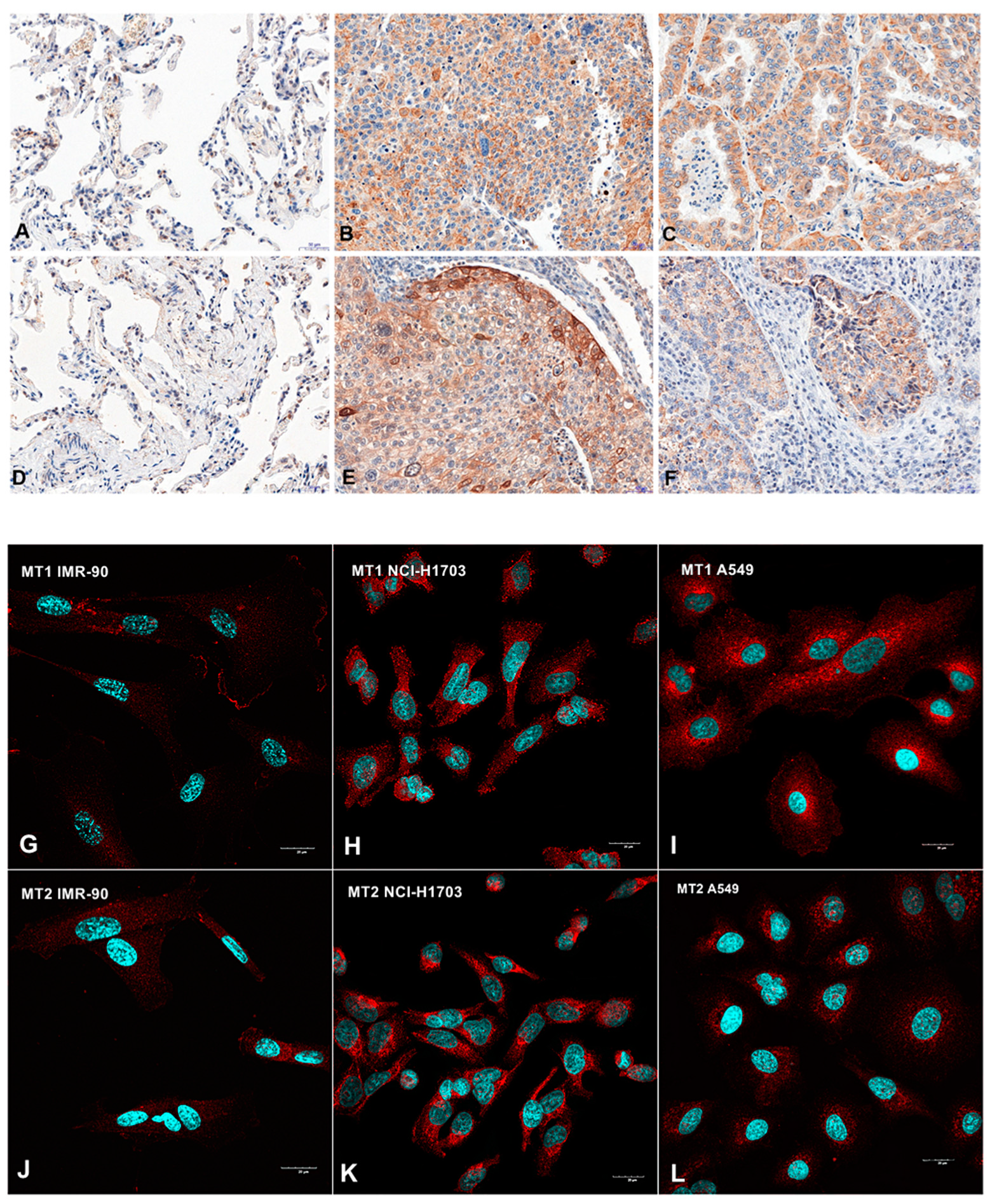 Cancers Free Full Text Prognostic Impact Of Melatonin Receptors Mt1 And Mt2 In Non Small Cell Lung Cancer Nsclc Html