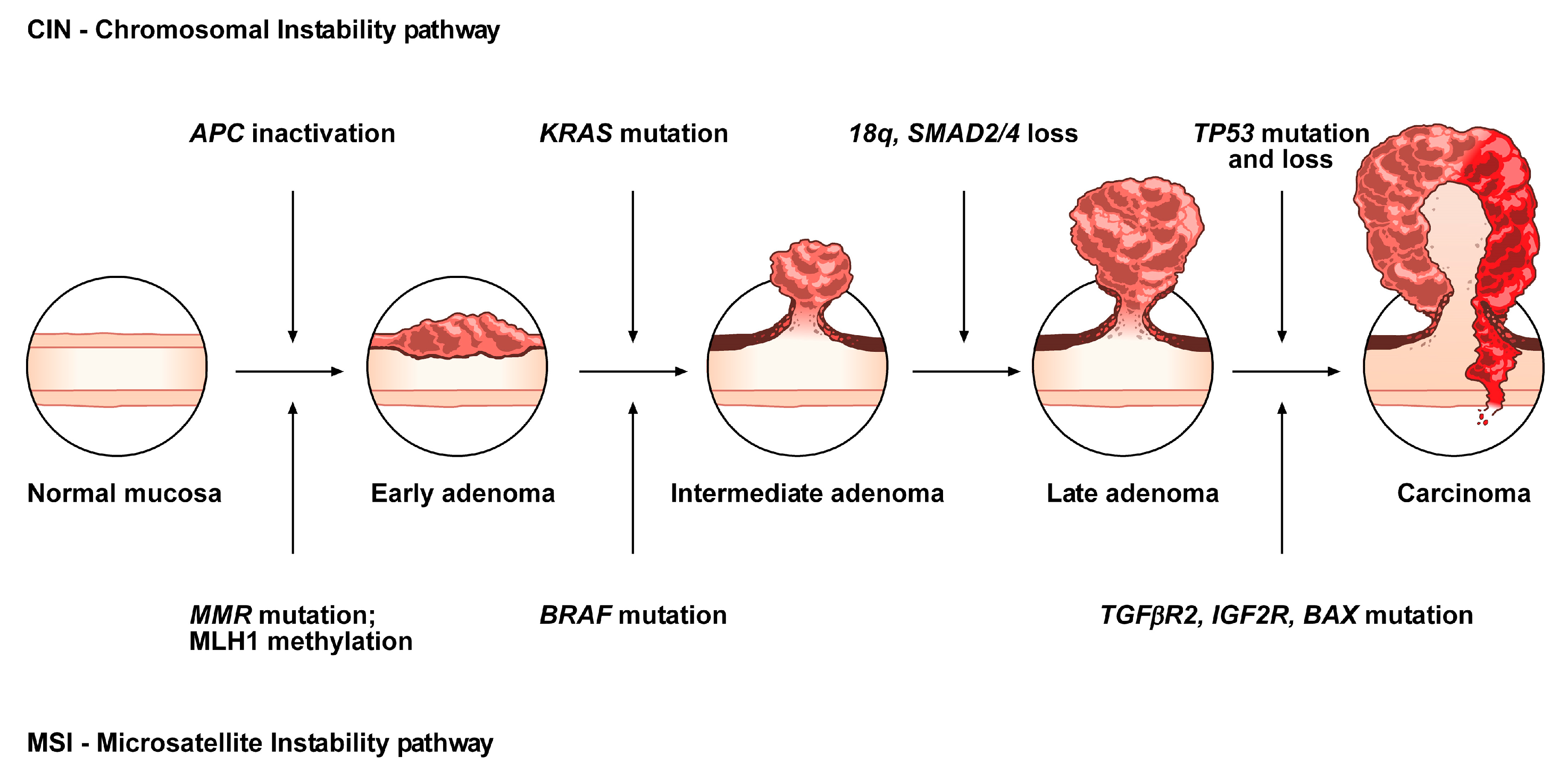 Colorectal Cancer Pathophysiology