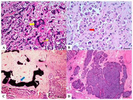 Morphology and Molecular Features of Rare Colorectal