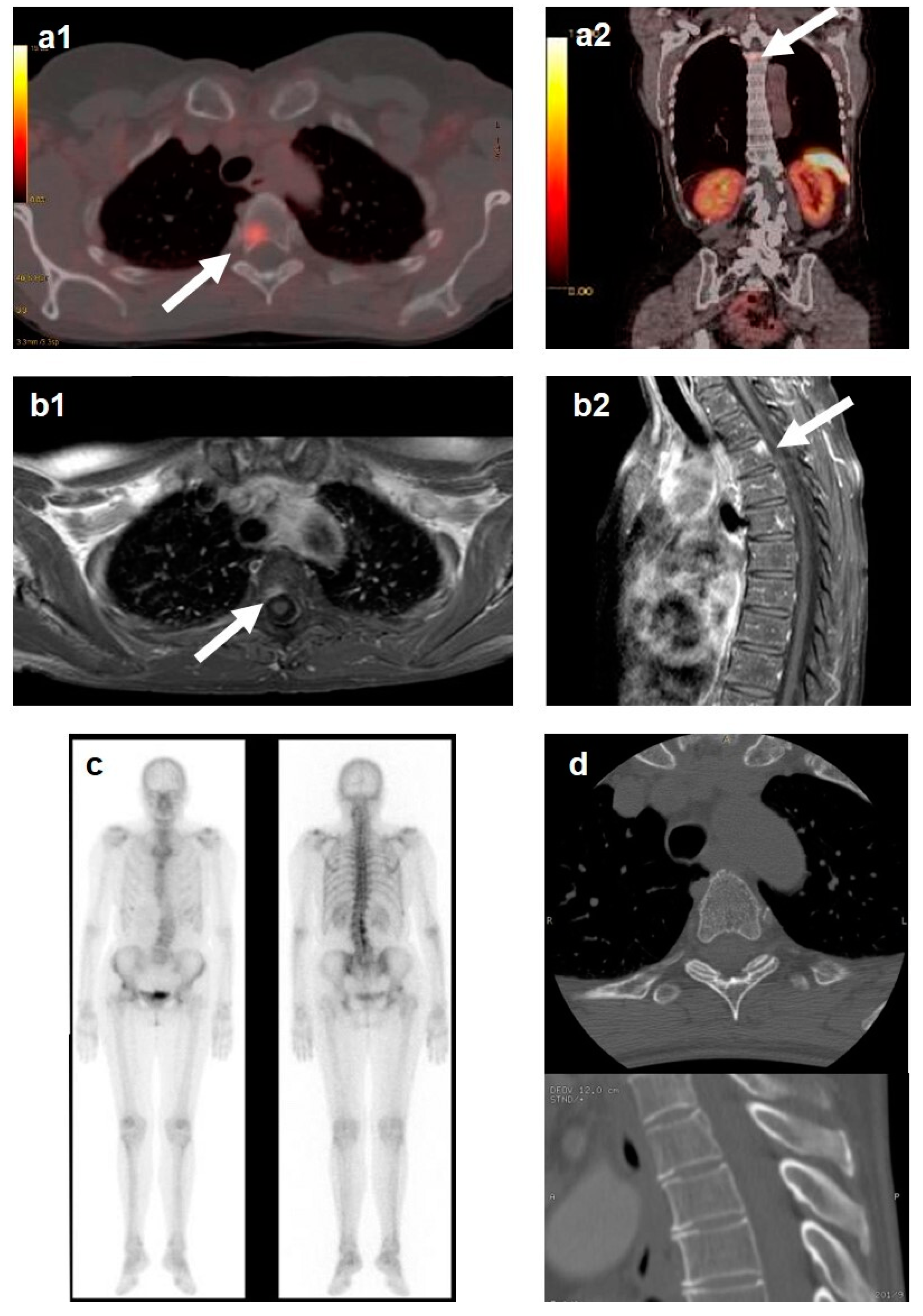 neuroendocrine cancer in bones
