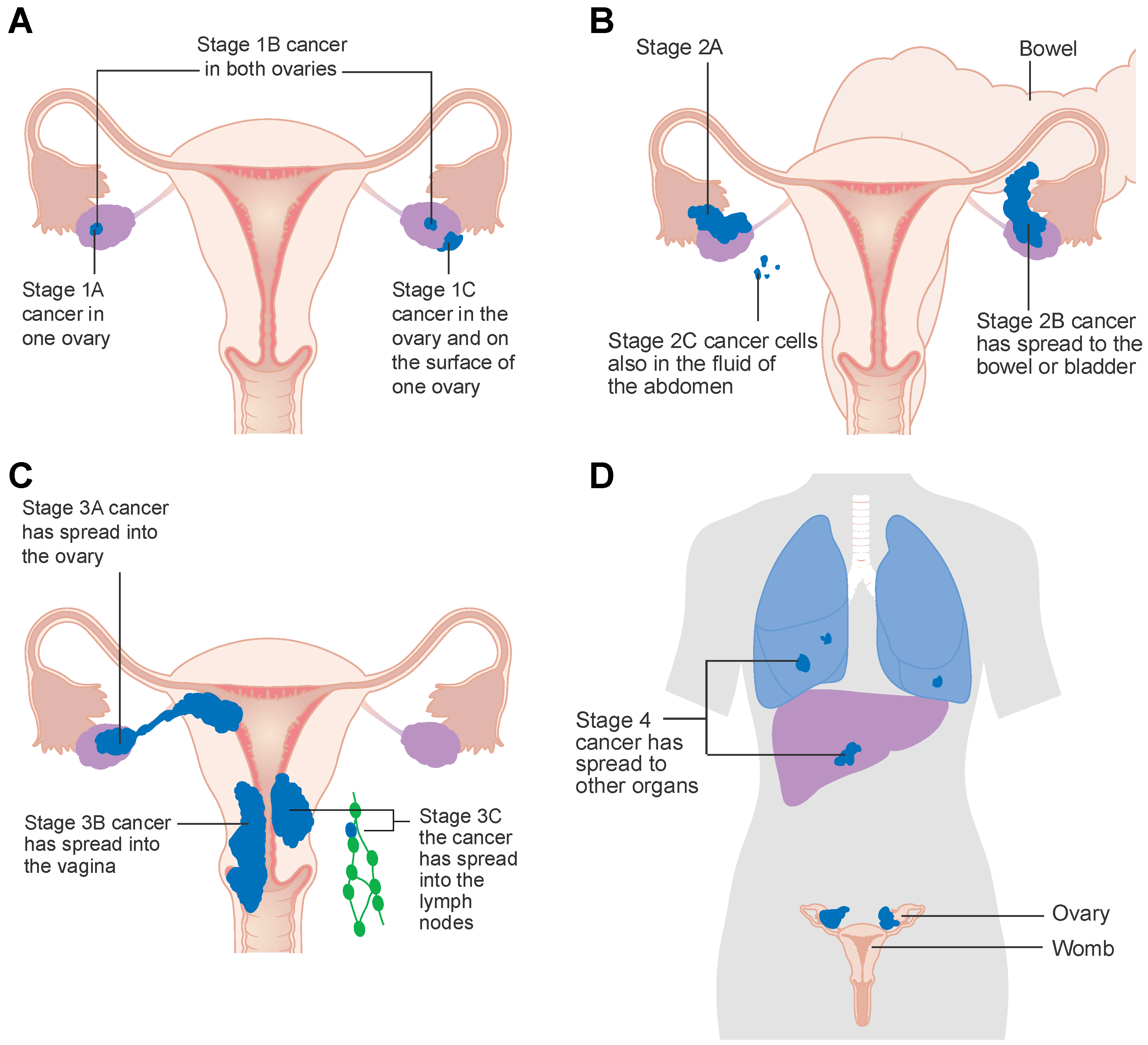 √ Stomach Stage 1 Ovarian Cancer Bloating Pictures Cancers Free Full 