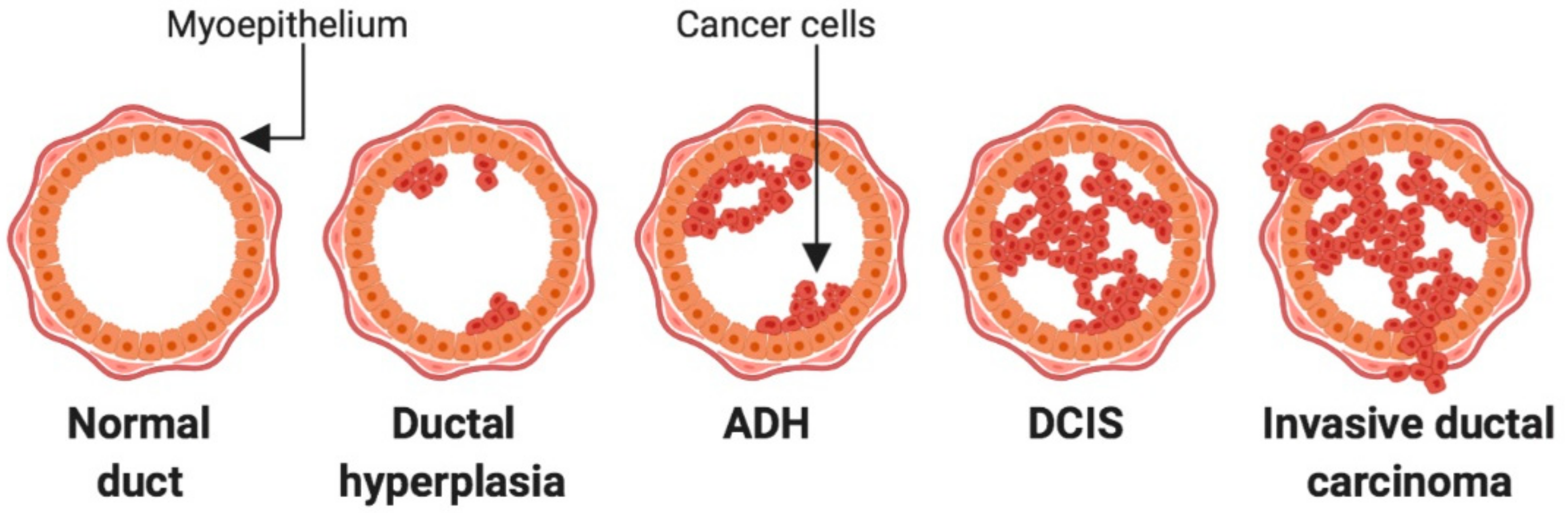 Cancers | Free Full-Text | The Immune Microenvironment of Breast Cancer Progression | HTML