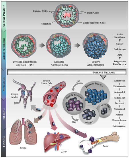 acinar adenocarcinoma prostate survival rate)