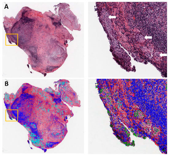 Artificial Intelligence in Lung Cancer Pathology Image Analysis