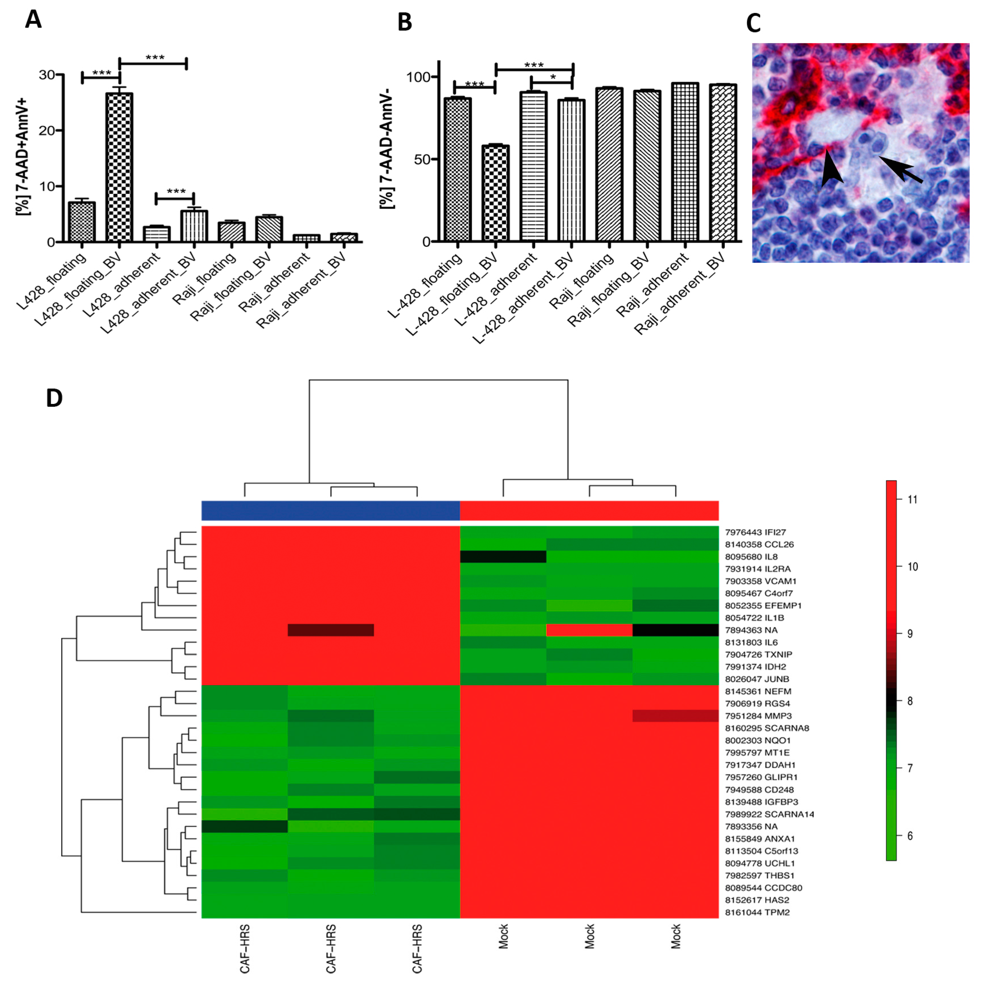 Cancers Free Full Text Fibroblasts In Nodular Sclerosing Classical Hodgkin Lymphoma Are Defined By A Specific Phenotype And Protect Tumor Cells From Brentuximab Vedotin Induced Injury Html