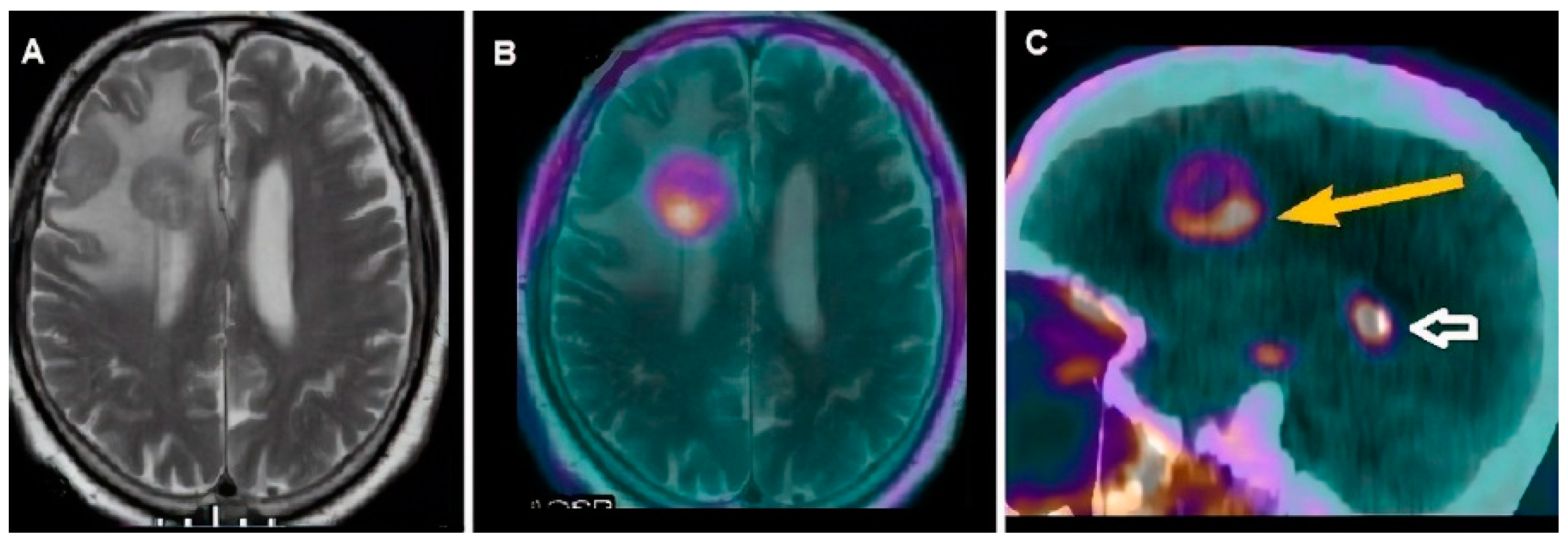 Cancers | Free Full-Text | Molecular Imaging in Pediatric Brain Tumors | HTML Cancers | Free Full-Text | Molecular Imaging in Pediatric Brain Tumors | HTML