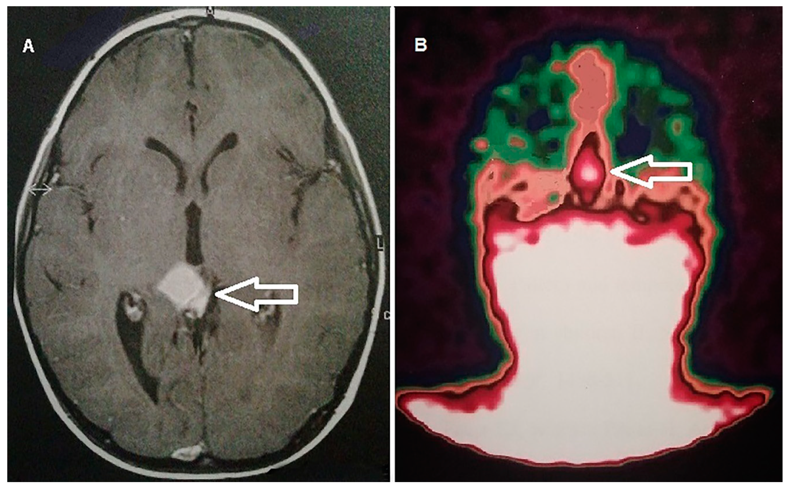 Cancers | Free Full-Text | Molecular Imaging in Pediatric Brain Tumors | HTML Cancers | Free Full-Text | Molecular Imaging in Pediatric Brain Tumors | HTML