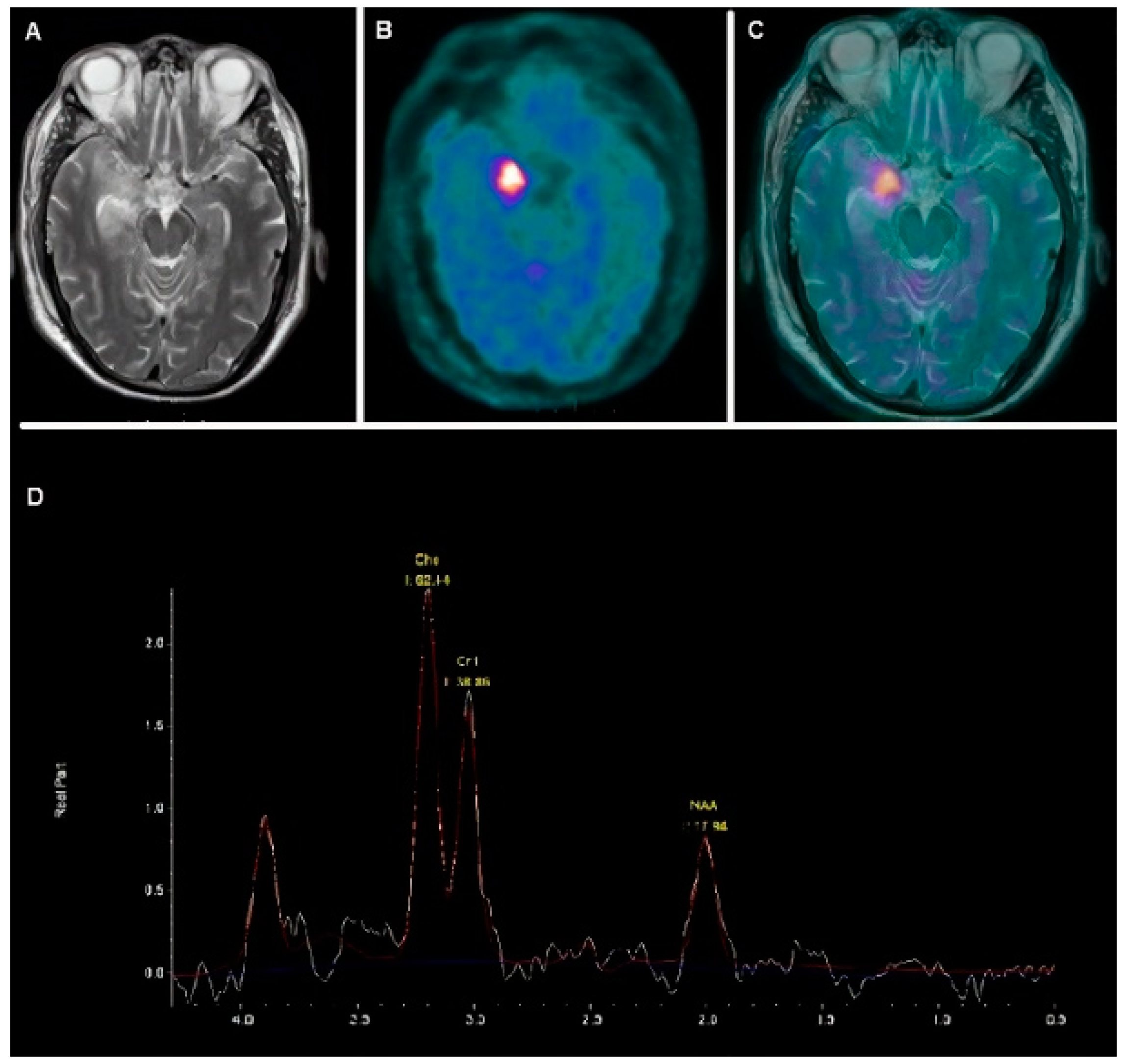 Cancers | Free Full-Text | Molecular Imaging in Pediatric Brain Tumors | HTML Cancers | Free Full-Text | Molecular Imaging in Pediatric Brain Tumors | HTML