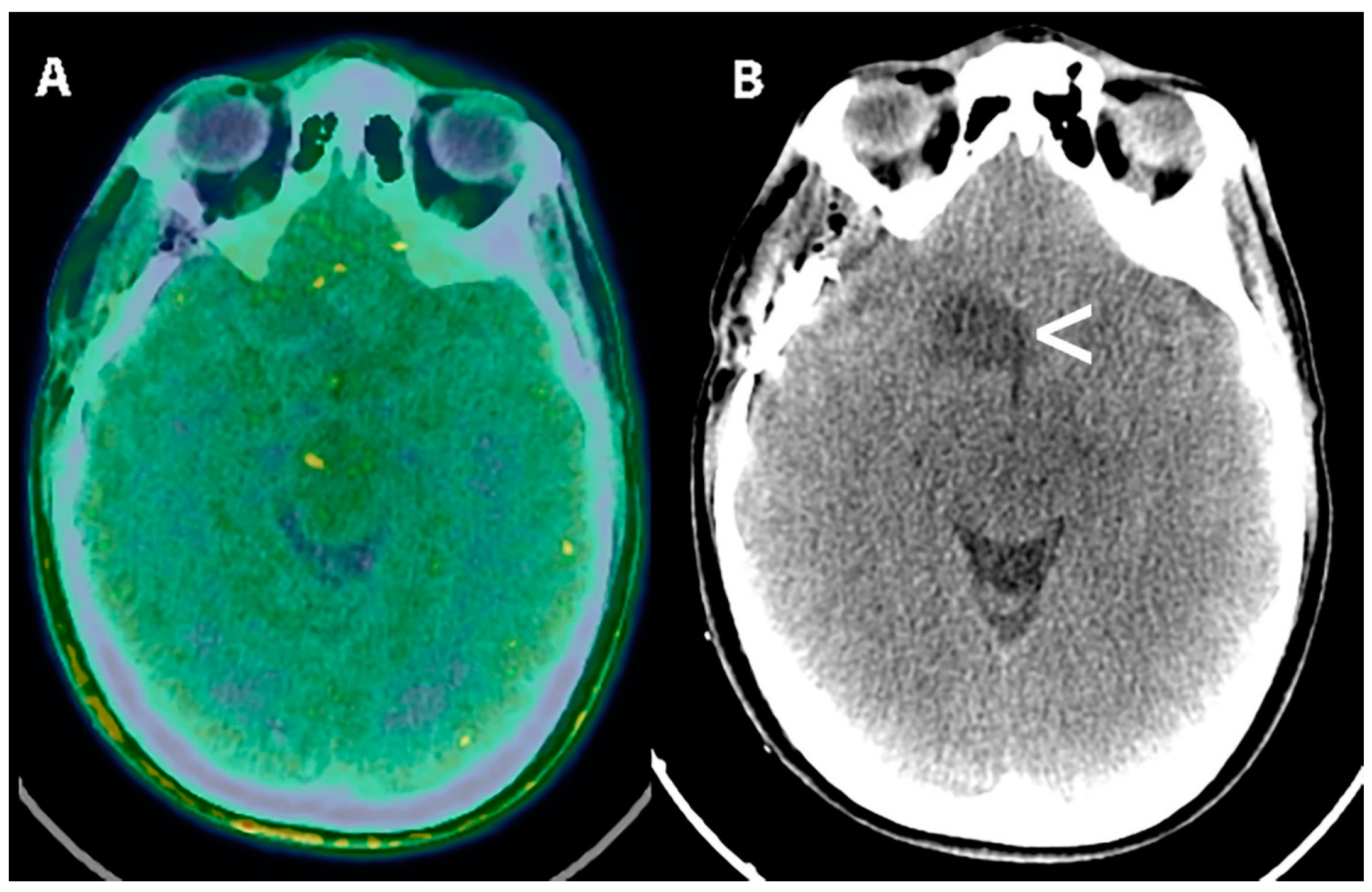 Cancers | Free Full-Text | Molecular Imaging in Pediatric Brain Tumors | HTML Cancers | Free Full-Text | Molecular Imaging in Pediatric Brain Tumors | HTML