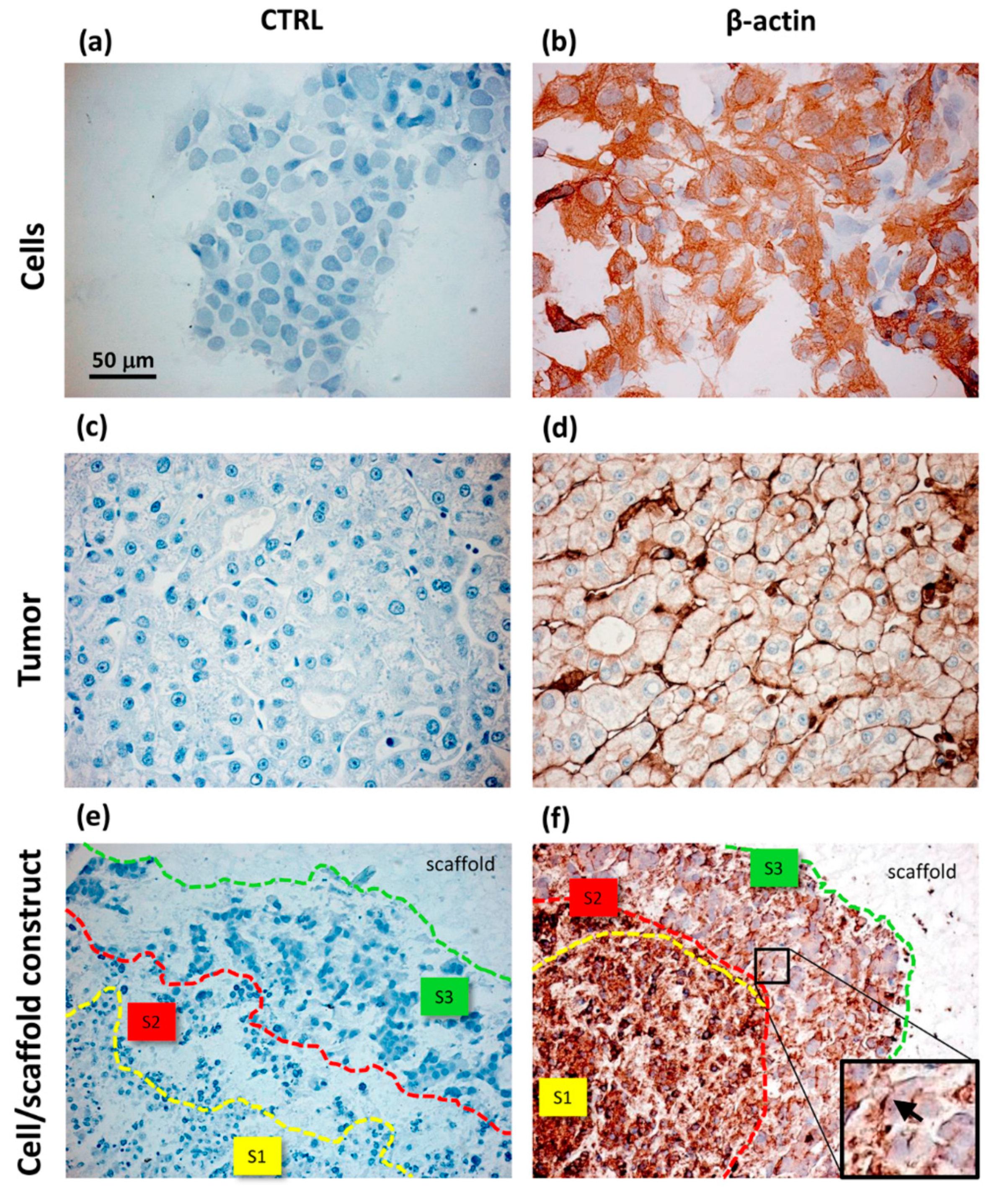 Liver Cancer: Current and Future Trends Using Biomaterials