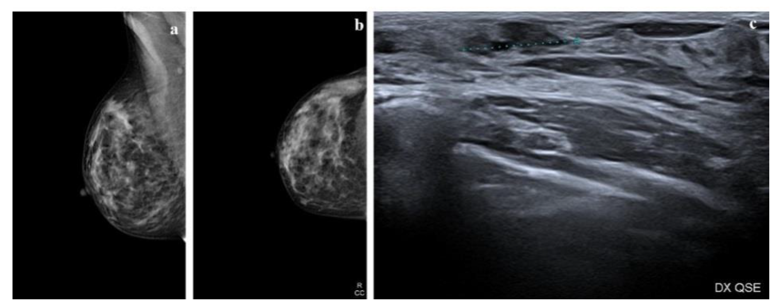 Cancers Free Full Text Ductal Carcinoma In Situ Of The Breast An