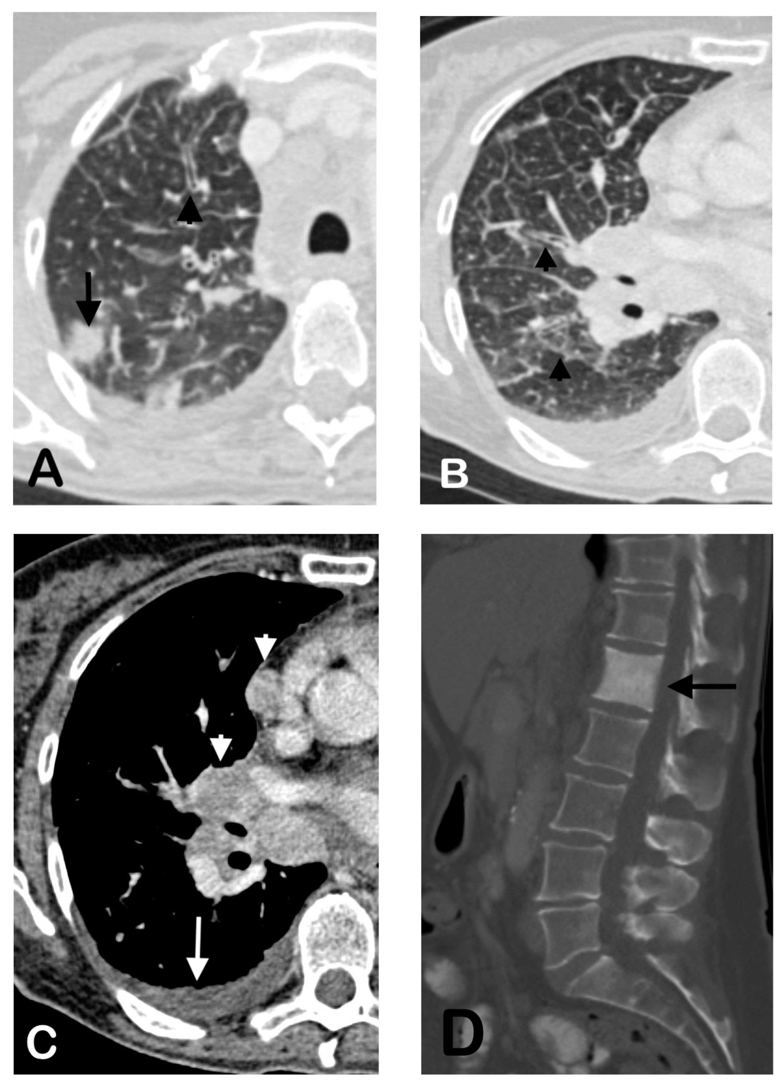 Cancers | Free Full-Text | Imaging Features and Patterns of Metastasis