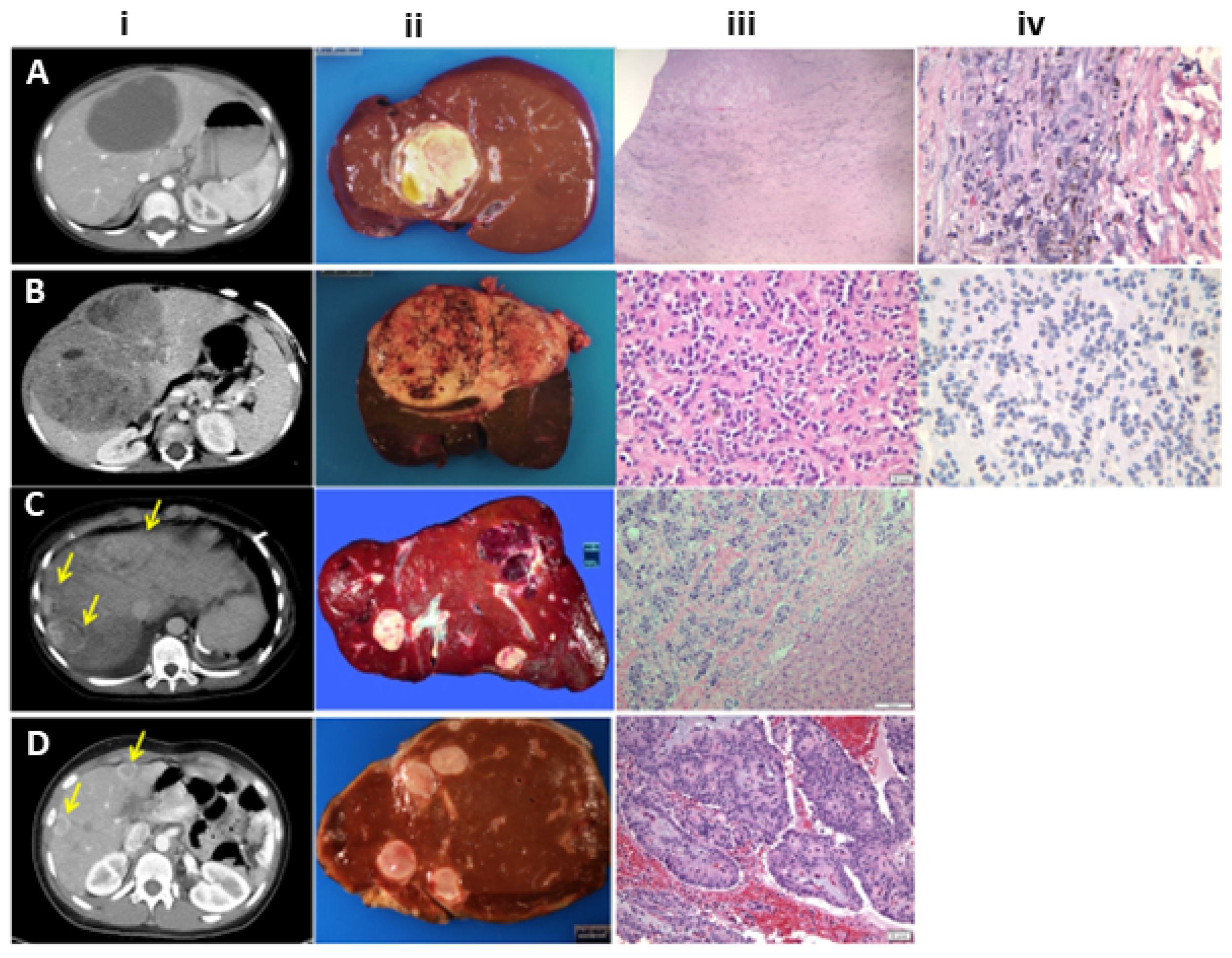 sarcoma cancer liver strevni paraziti u psa