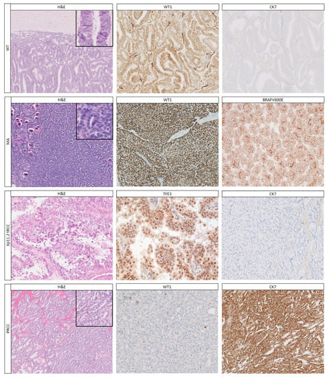 Cancers Free Full Text Renal Tumors Of Childhood A Histopathologic Pattern Based Diagnostic Approach Html