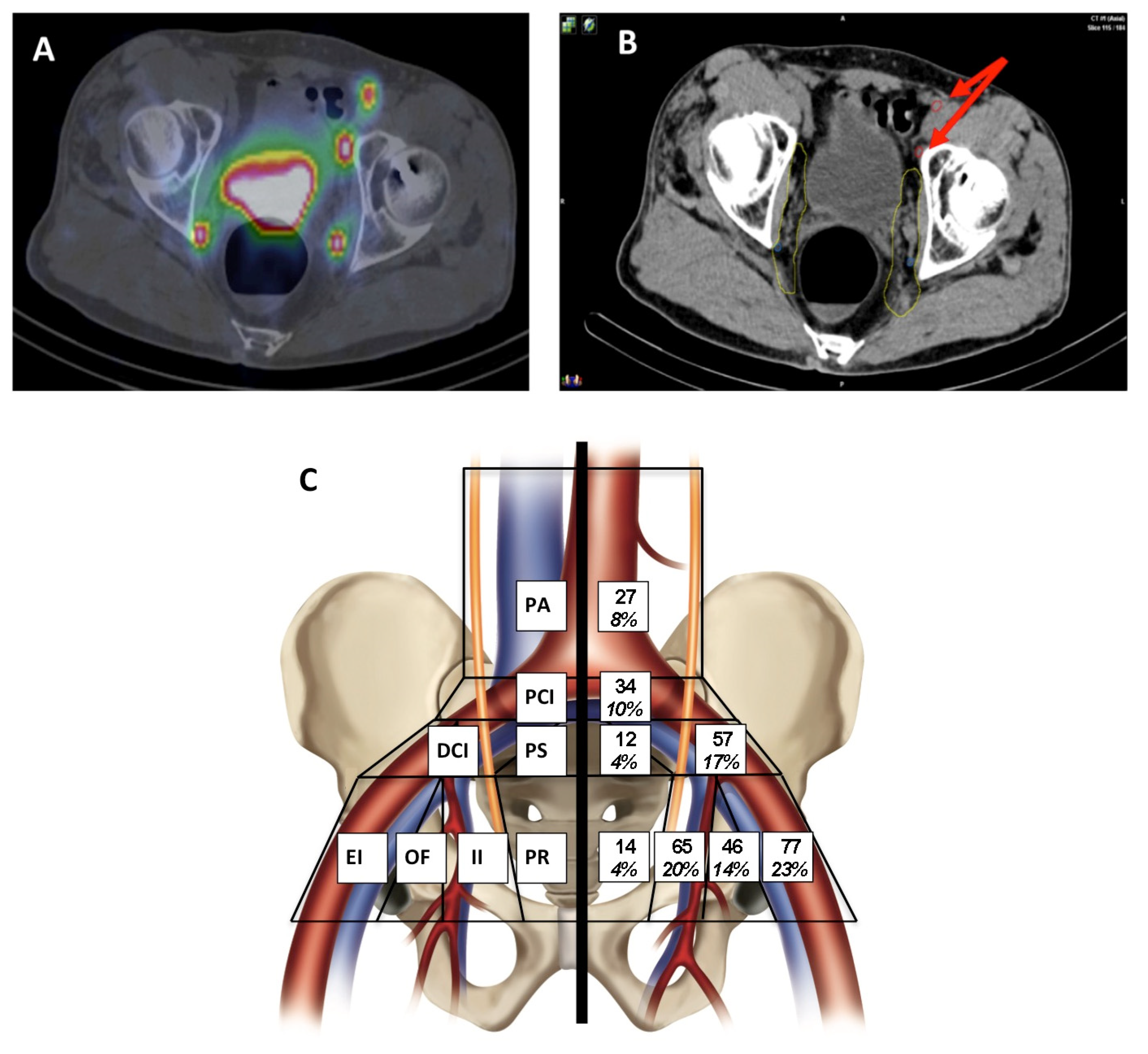 pci prostate cancer