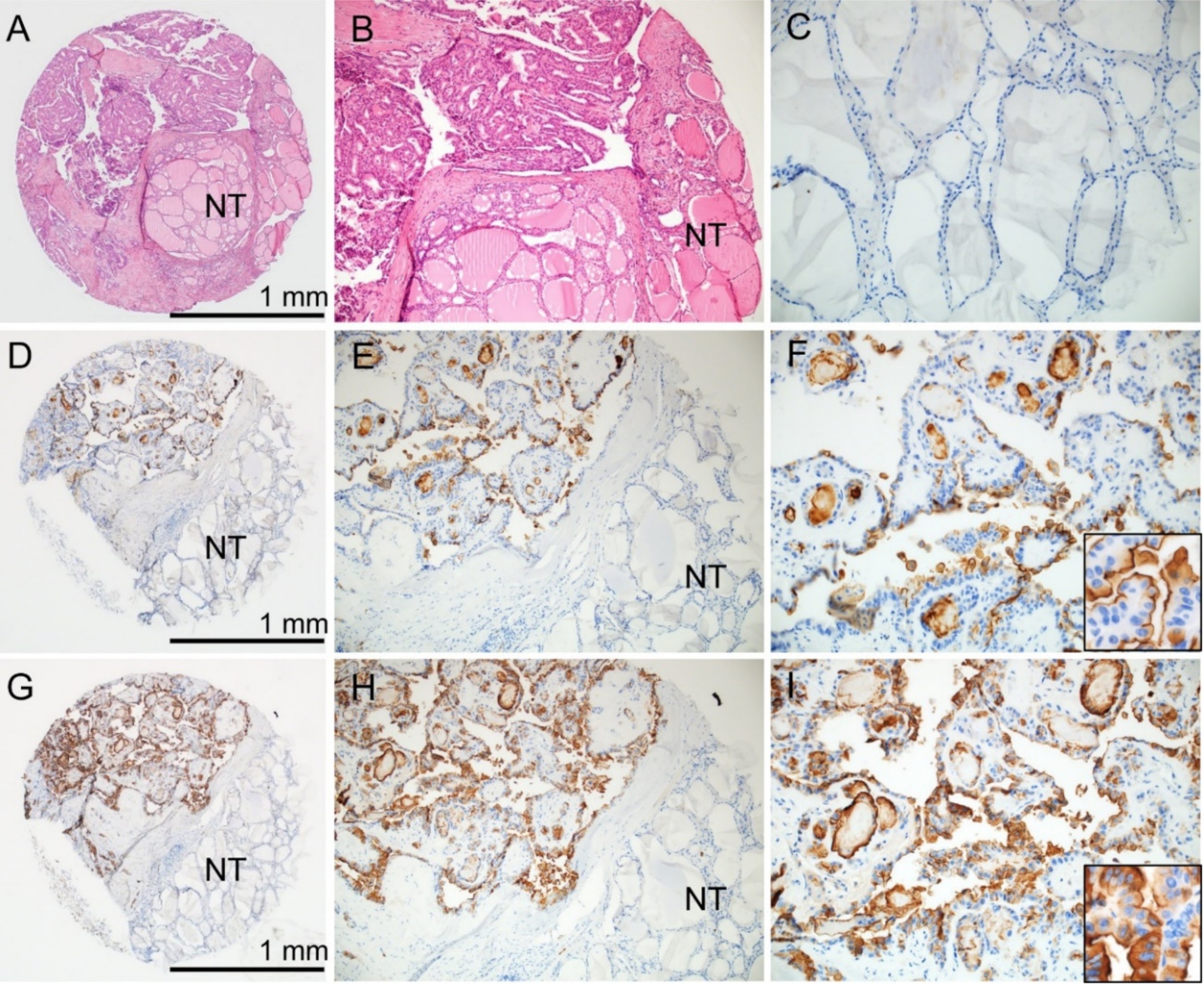 Molecular Imaging and Theragnostics of Thyroid Cancers