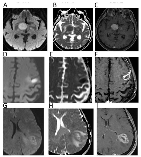 Cancers Free Full Text Diffusion Weighted Imaging In Oncology An Update Html