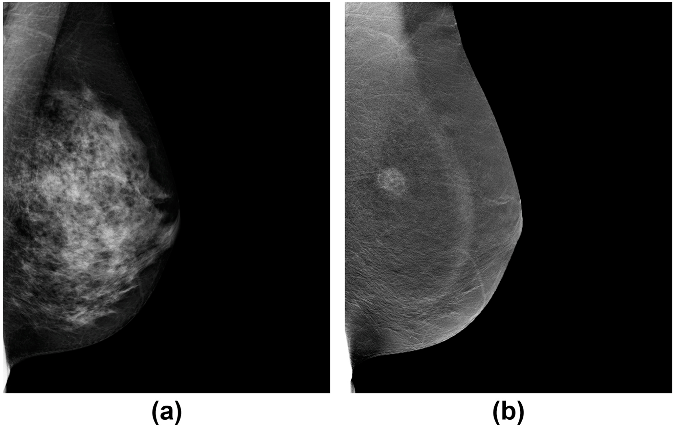 Маммография периодичность. Контрастная спектральная маммография. Двуэнергетическая контрастная спектральная маммография (Cesm). Двухэнергетическая маммография.