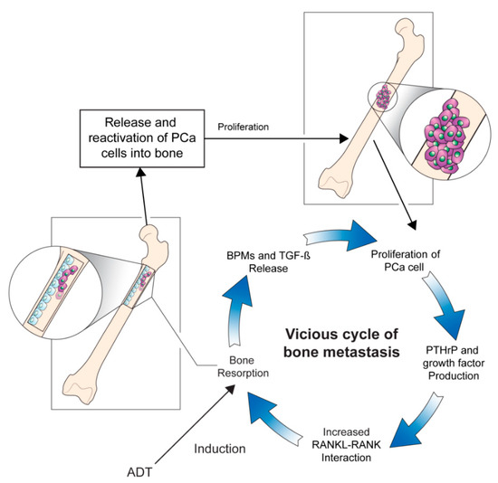 prostate stage fibrosis