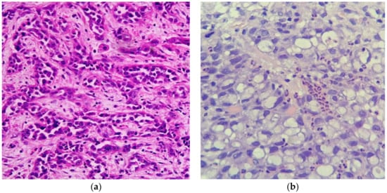 PDF) Primary signet ring cell carcinoma of the appendix: a rare case report  and our 18-year experience