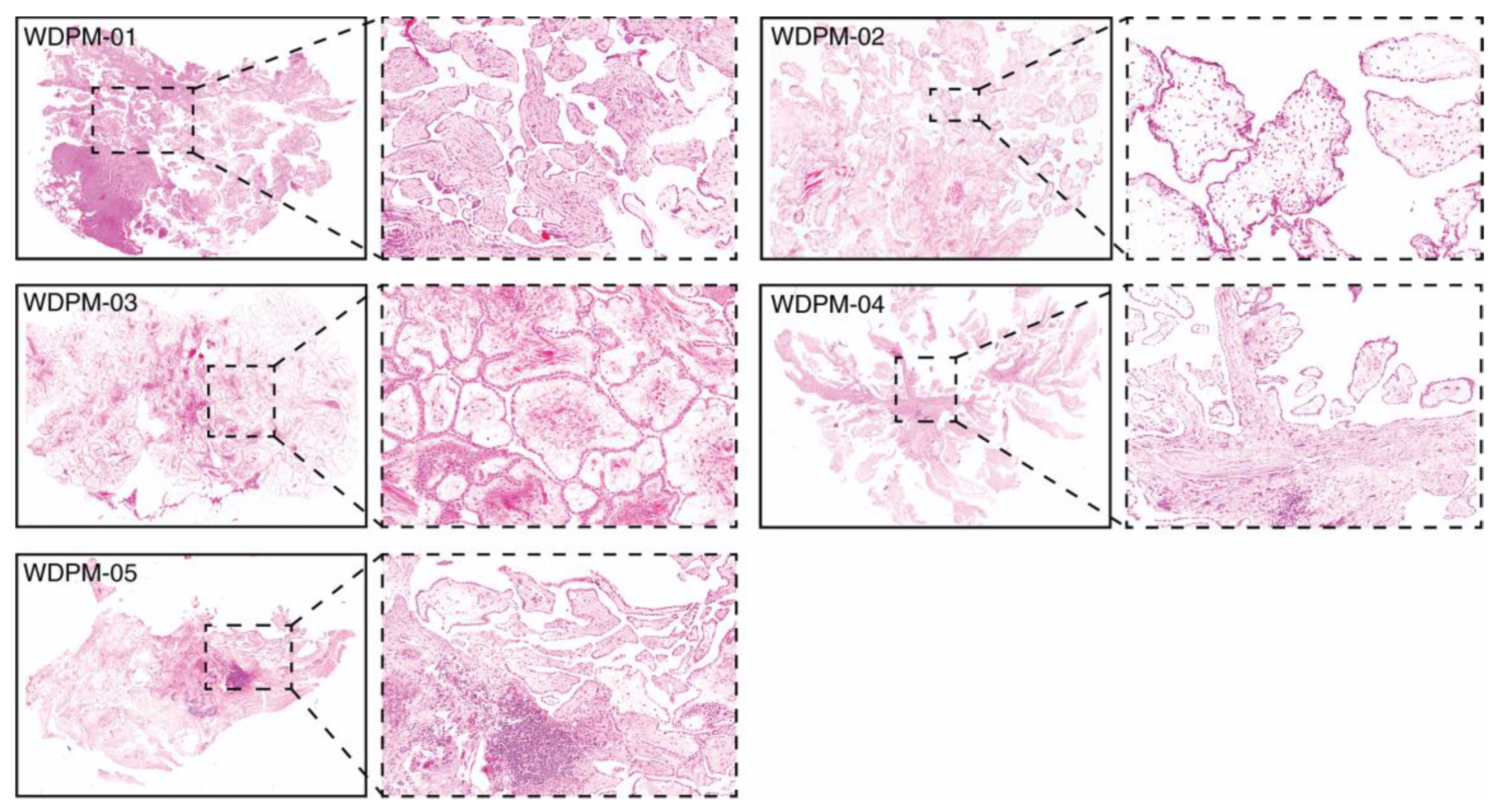 peritoneal mesothelioma and endometriosis