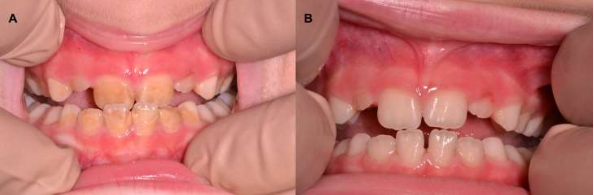 Leukemia Oral Symptoms