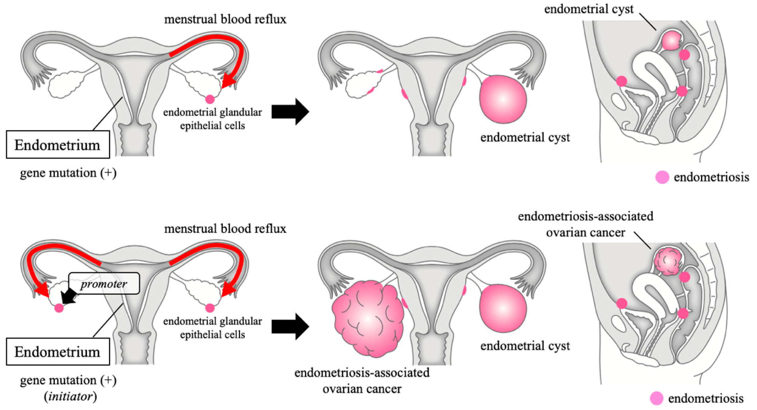 cancer ovarian endometriosis