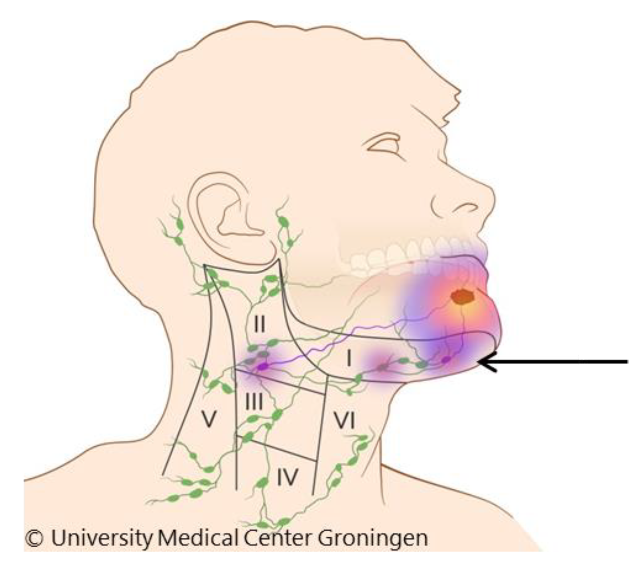 metastatic cancer lymph node neck