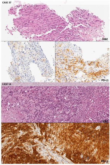 Digital Pathology and PD-L1 Testing in Non Small Cell Lung Cancer: A ...