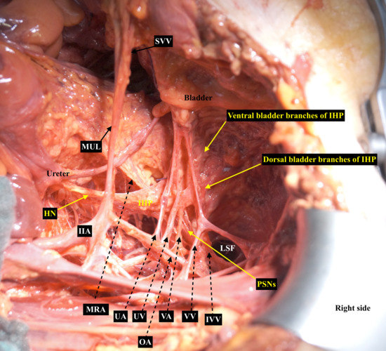 Cancers | Free Full-Text | A Concise Paradigm on Radical Hysterectomy