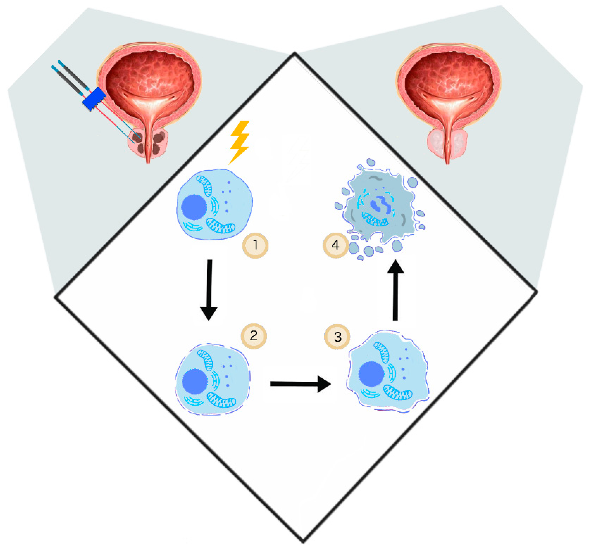 Cancers Free Full Text Electroporation Based Treatments In Urology Html Cancers Free Full Text Electroporation Based Treatments In Urology Html