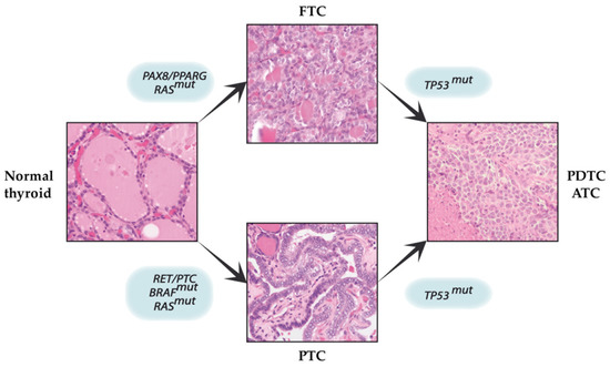 Cancers Free Full Text The Possible Role Of Cancer Stem Cells In The Resistance To Kinase Inhibitors Of Advanced Thyroid Cancer Html