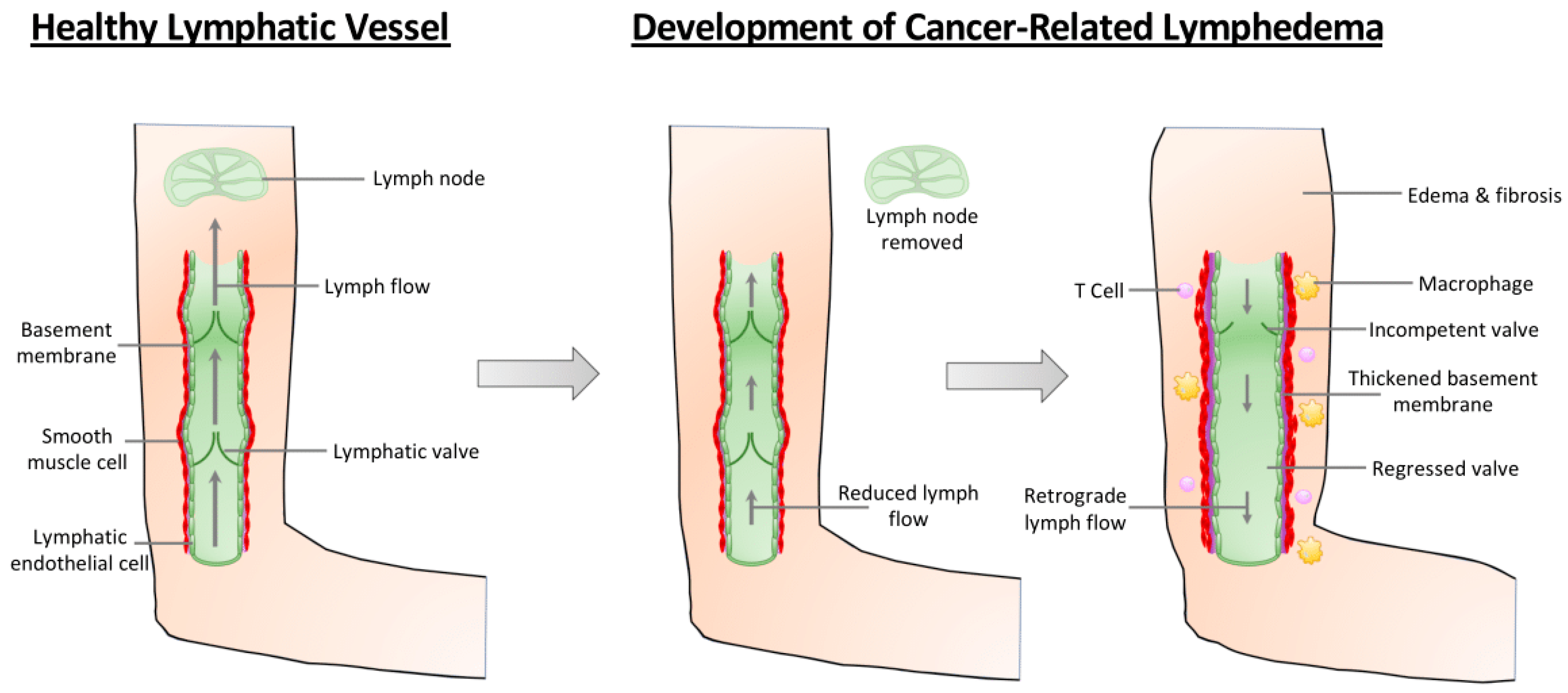Cancers | Free Full-Text | Lymphatic Valves and Lymph Flow in Cancer-Related Lymphedema