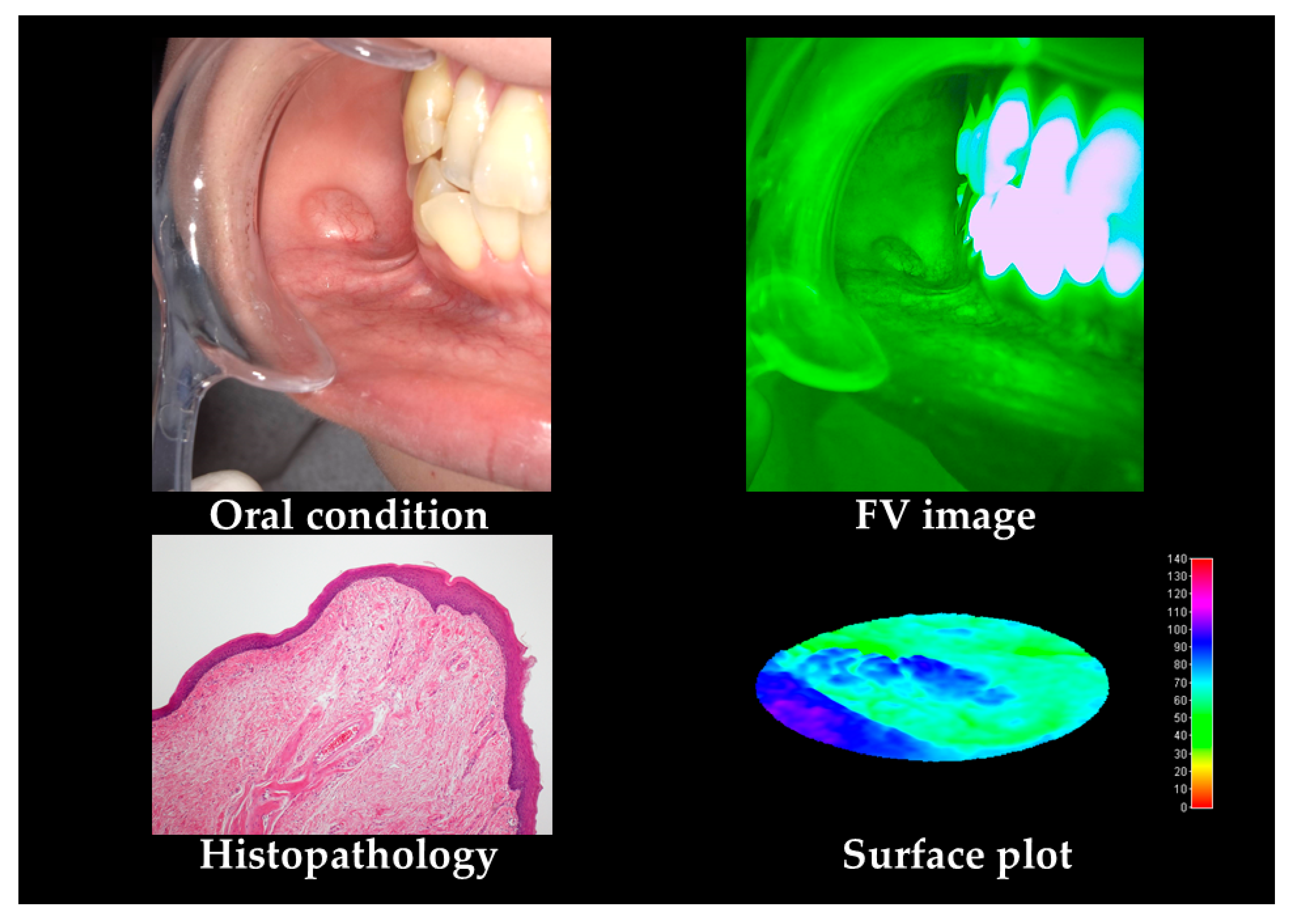 Cancers Free Full Text Non Invasive Early Detection Of Oral Cancers