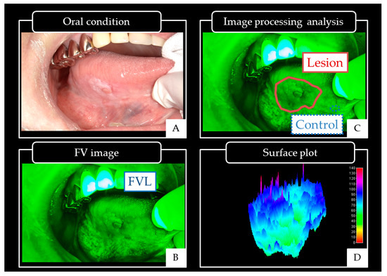 Cancers Free Full Text Non Invasive Early Detection Of Oral Cancers 