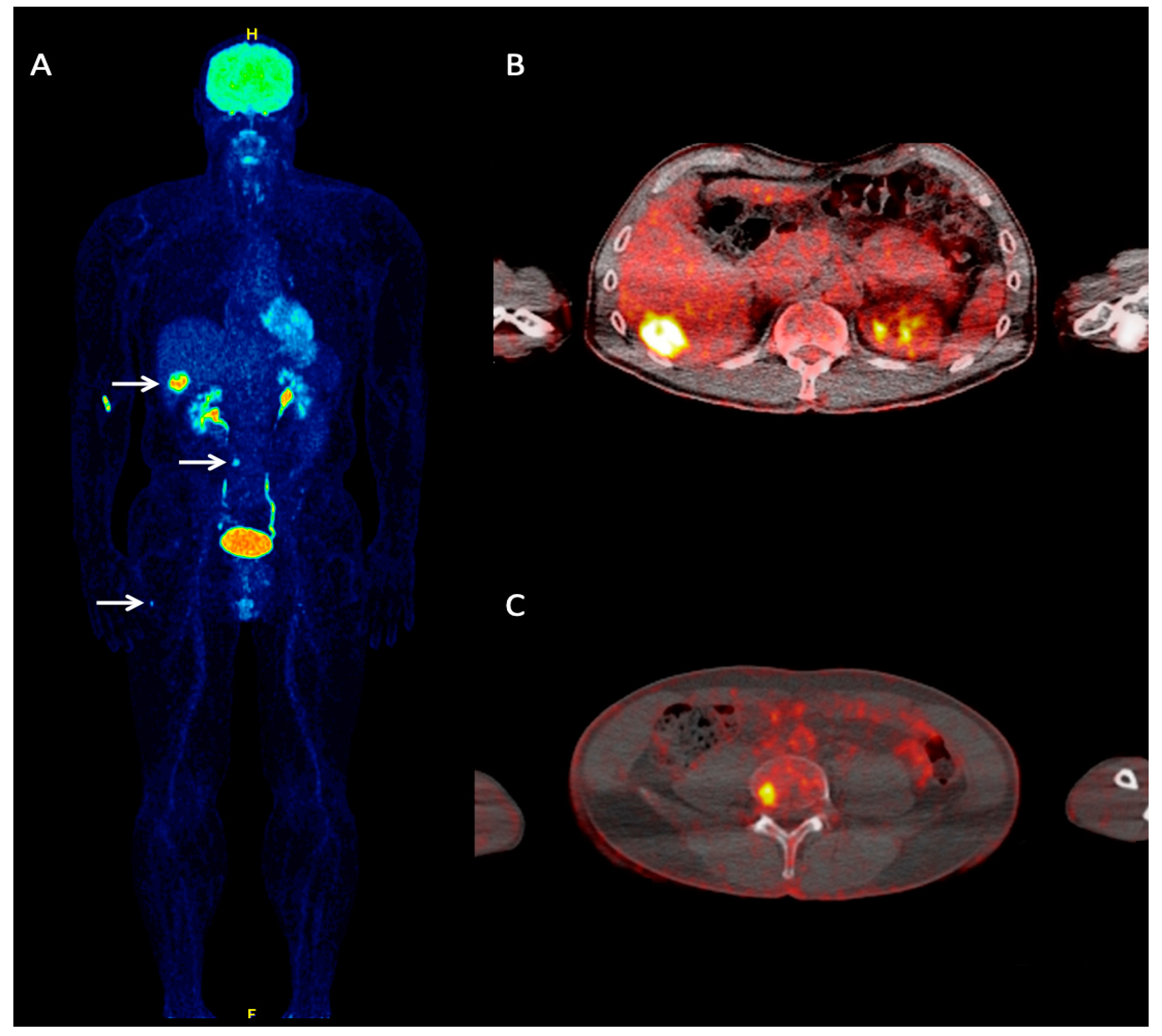 Cancers Free Full Text Positron Emission Tomography In Merkel Cell Carcinoma Html
