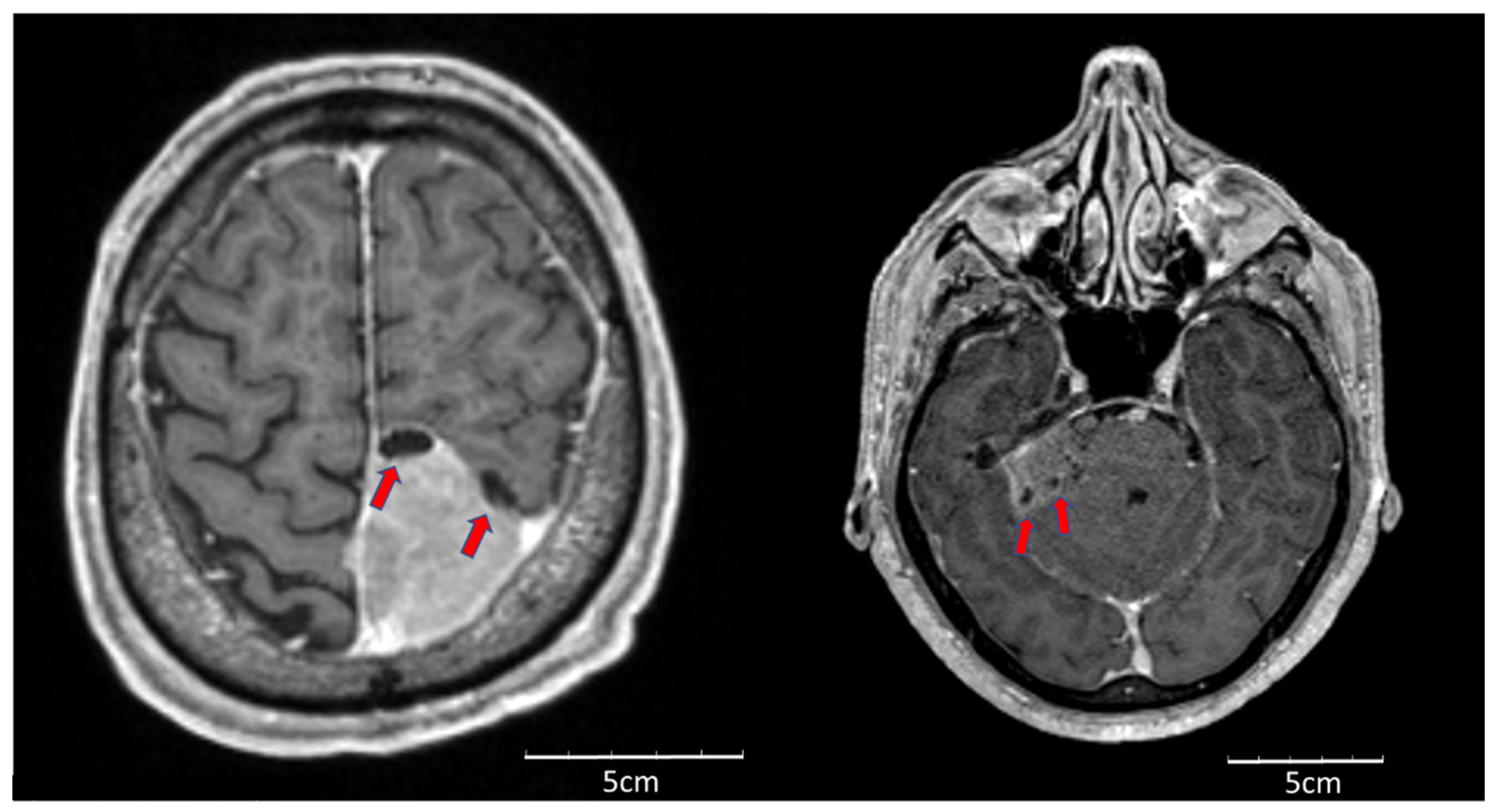 健康・医学 Meningiomas, Part II (Volume 170) i2 Meningiomas, Part II (Volume 170) i2 健康・医学