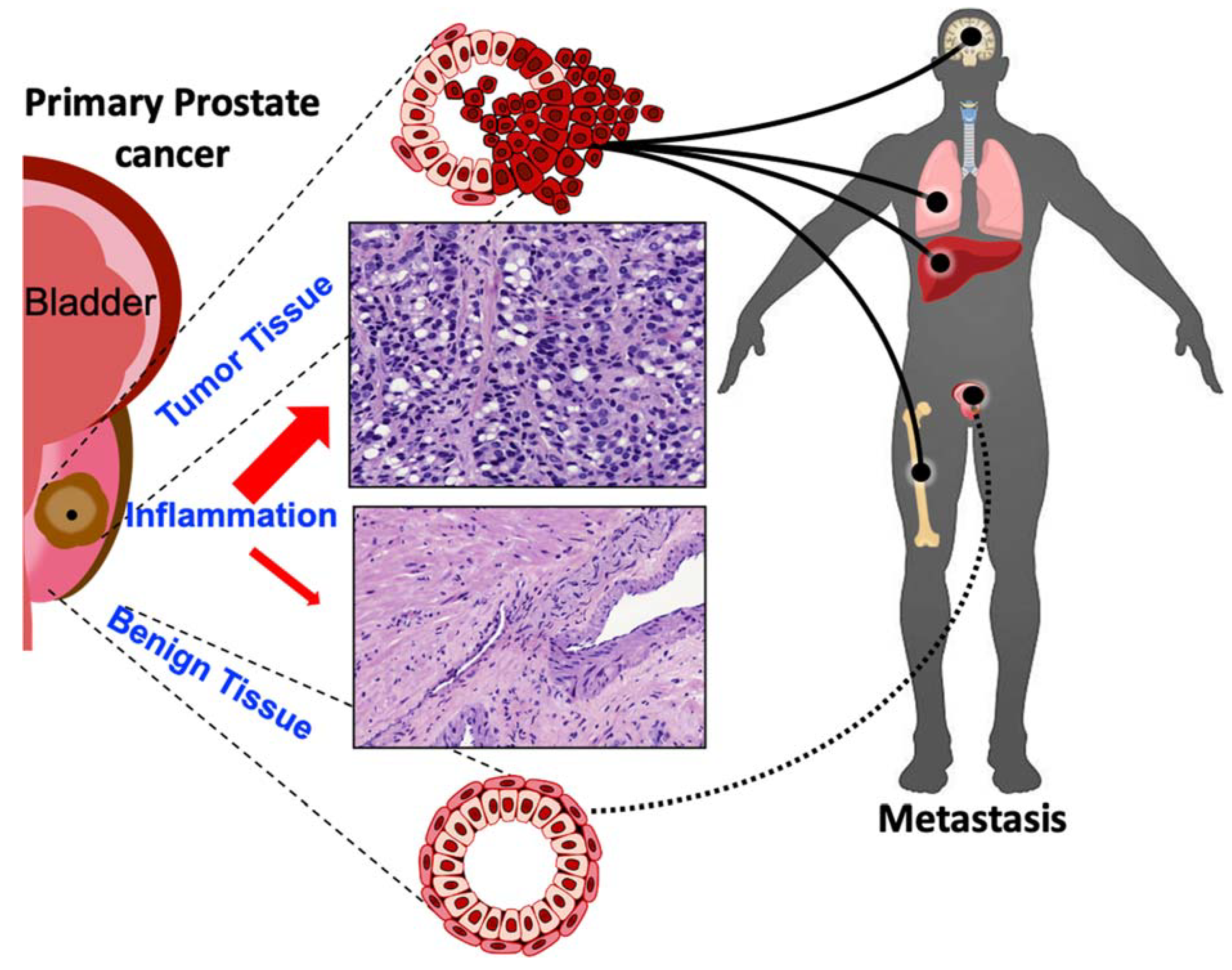 prostate cancer metastasis