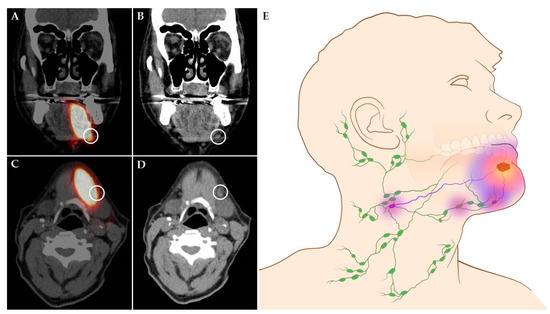 early stage cancer lymph nodes in neck