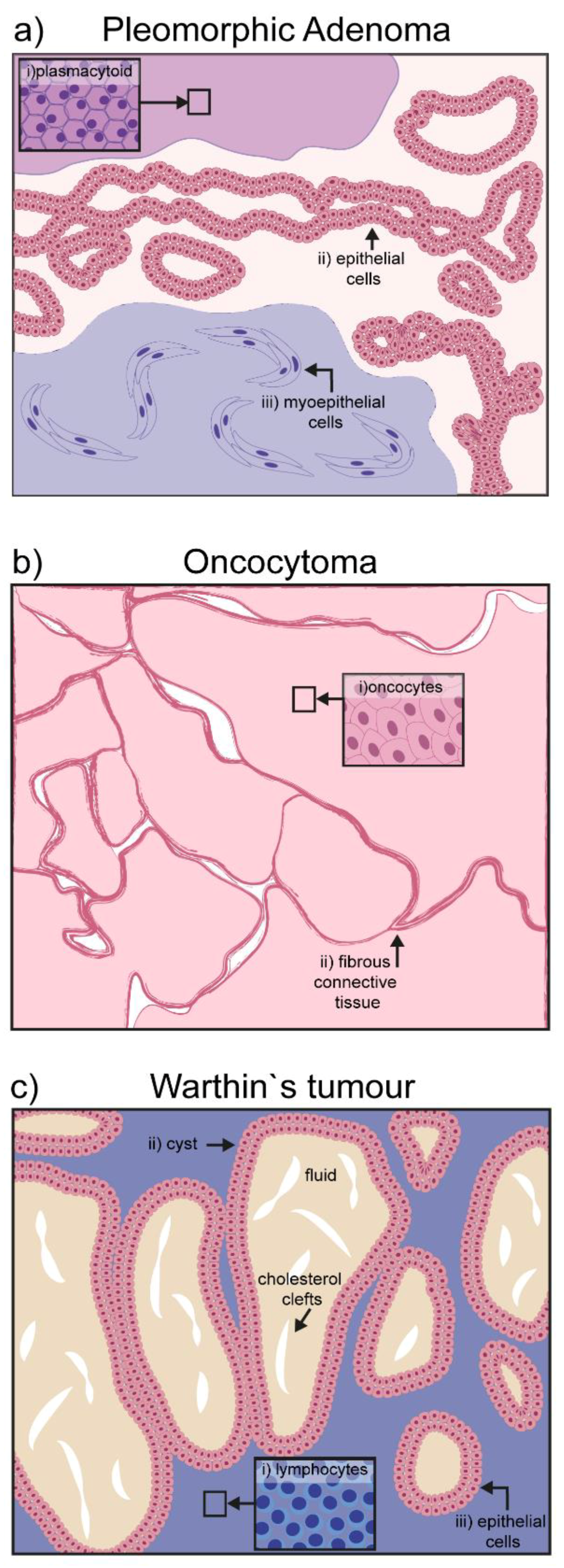 pleomorphic adenoma treatment guidelines