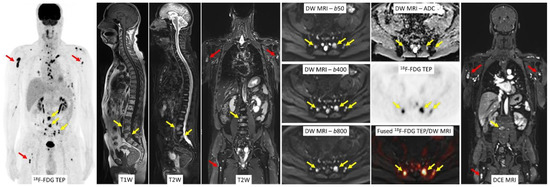 Whole-Body Functional MRI and PET/MRI in Multiple Myeloma