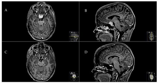 Midline Meningiomas of the Anterior Skull Base: Surgical