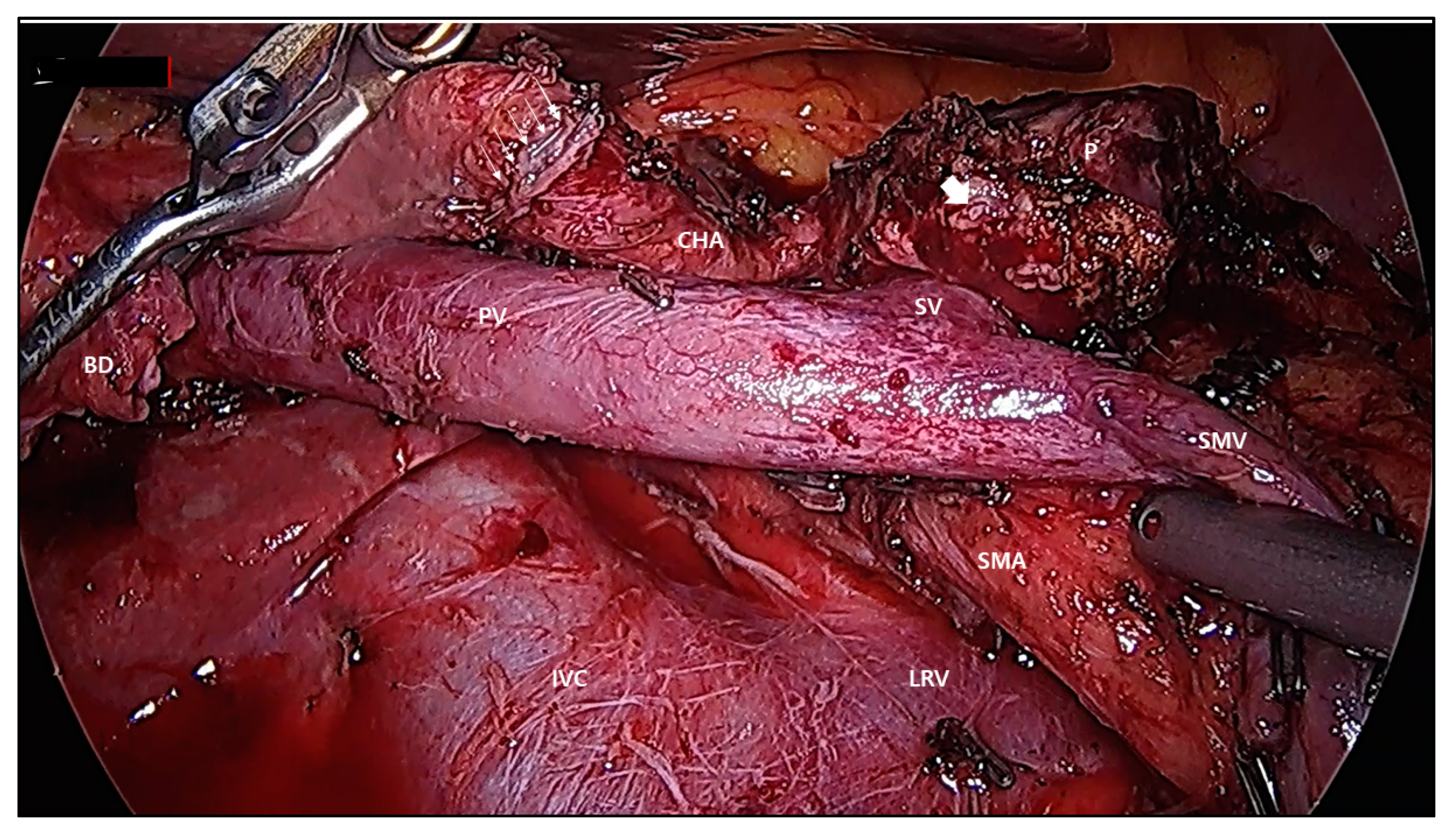reoid cancer laparoscopic life impulse detox