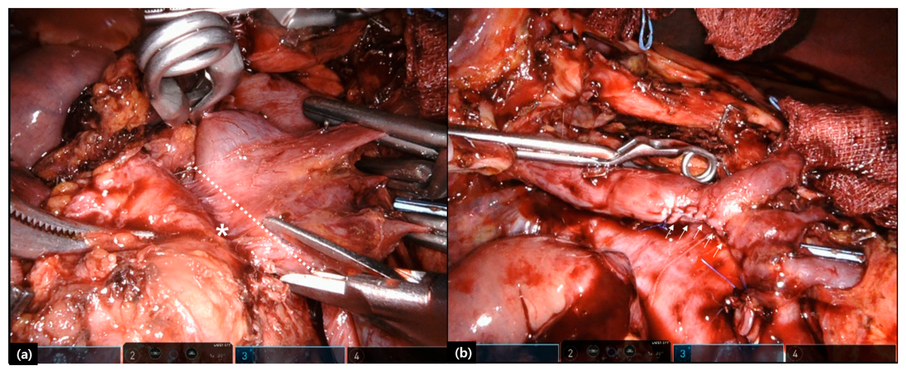 reoid cancer laparoscopic